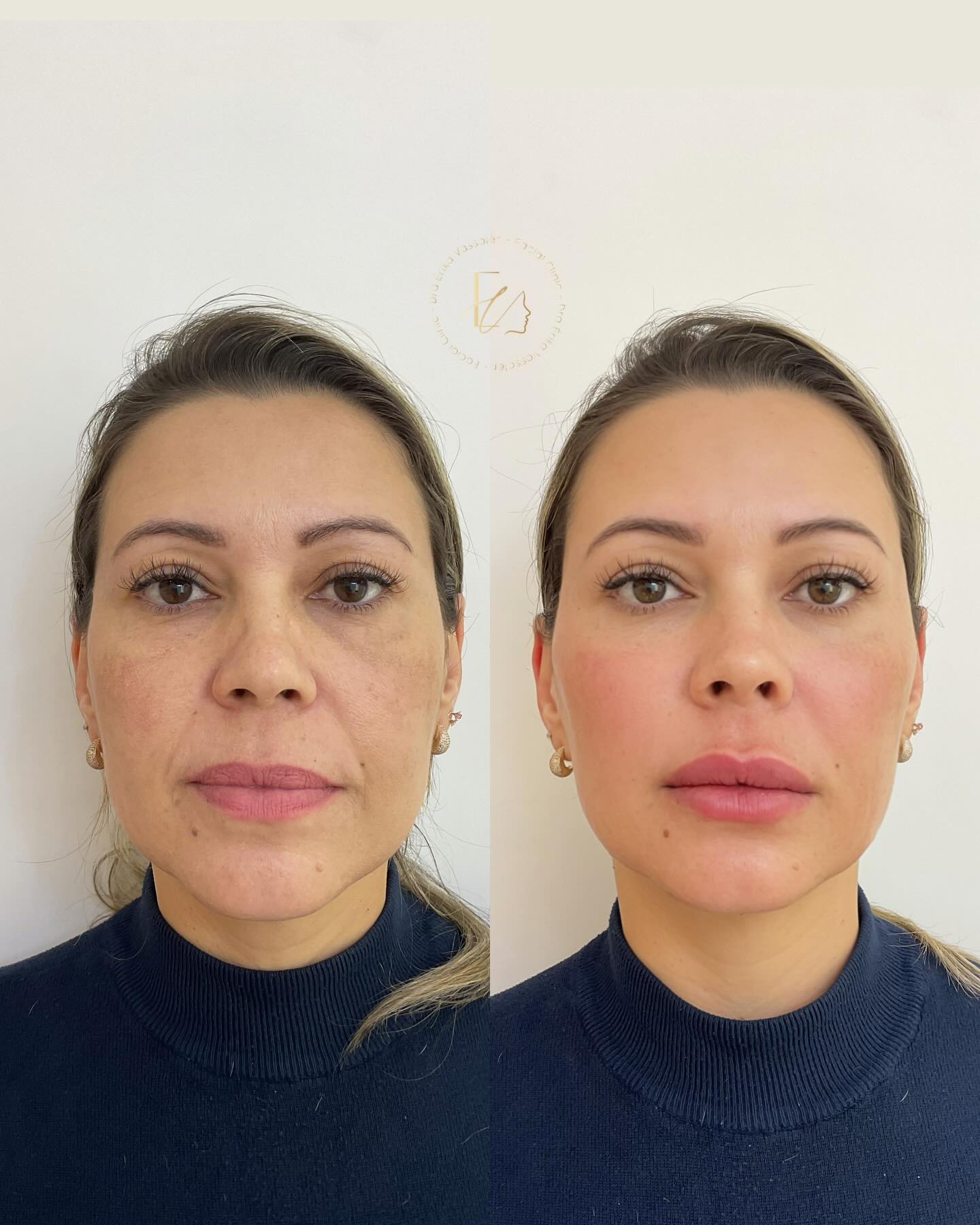 Dra Érika Vassolér Guerrero Puccia Facebook ad: Sandra sempre foi linda.