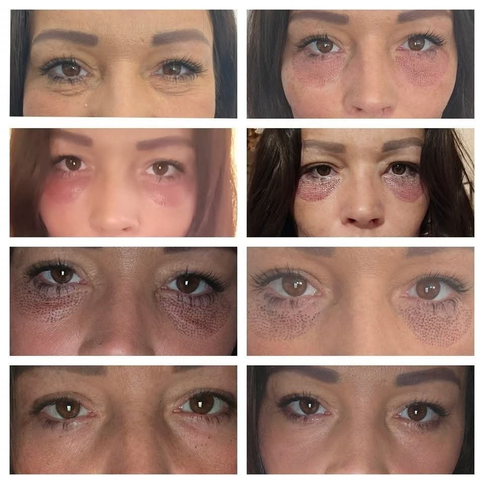 Plasma Aesthetics North-West & Skin Care Clinic Facebook ad: So Gem had her Under Eye Plasma Fibroblast…
