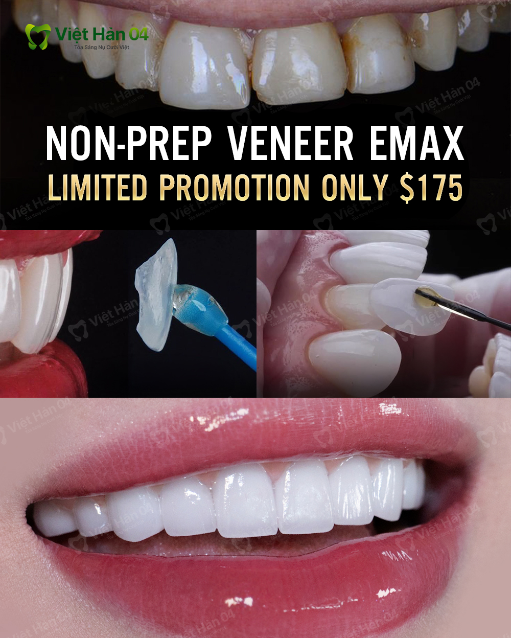 Nha Khoa Thẩm Mỹ Việt Hàn 04 Răng Toàn Sứ Giá Xưởng HCM Facebook ad: Swiss No-prep Emax Veneer only $175 - Smile Makeover in 2…