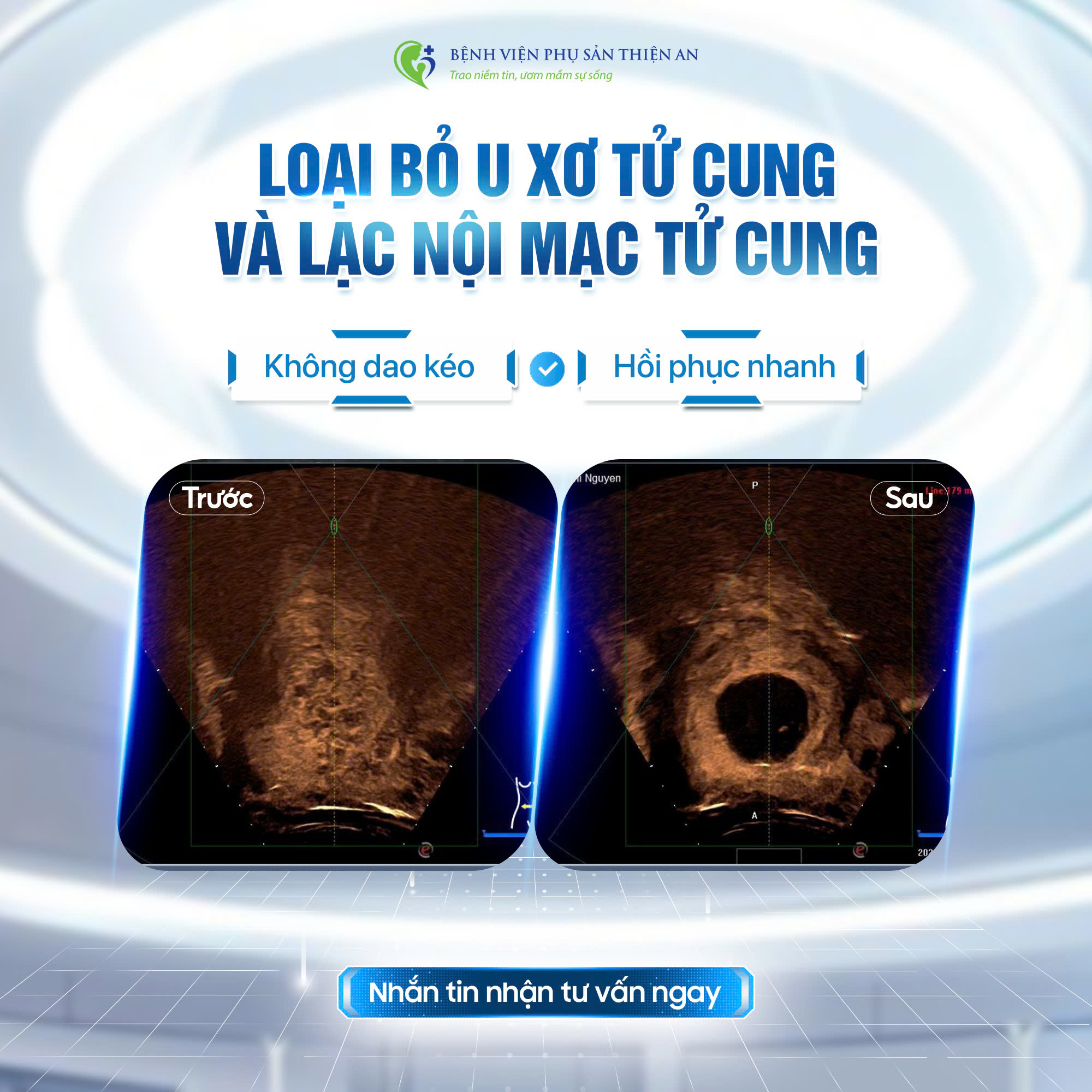 Bệnh Viện Phụ Sản Thiện An Facebook ad: Điều trị khối U không dùng dao kéo >>