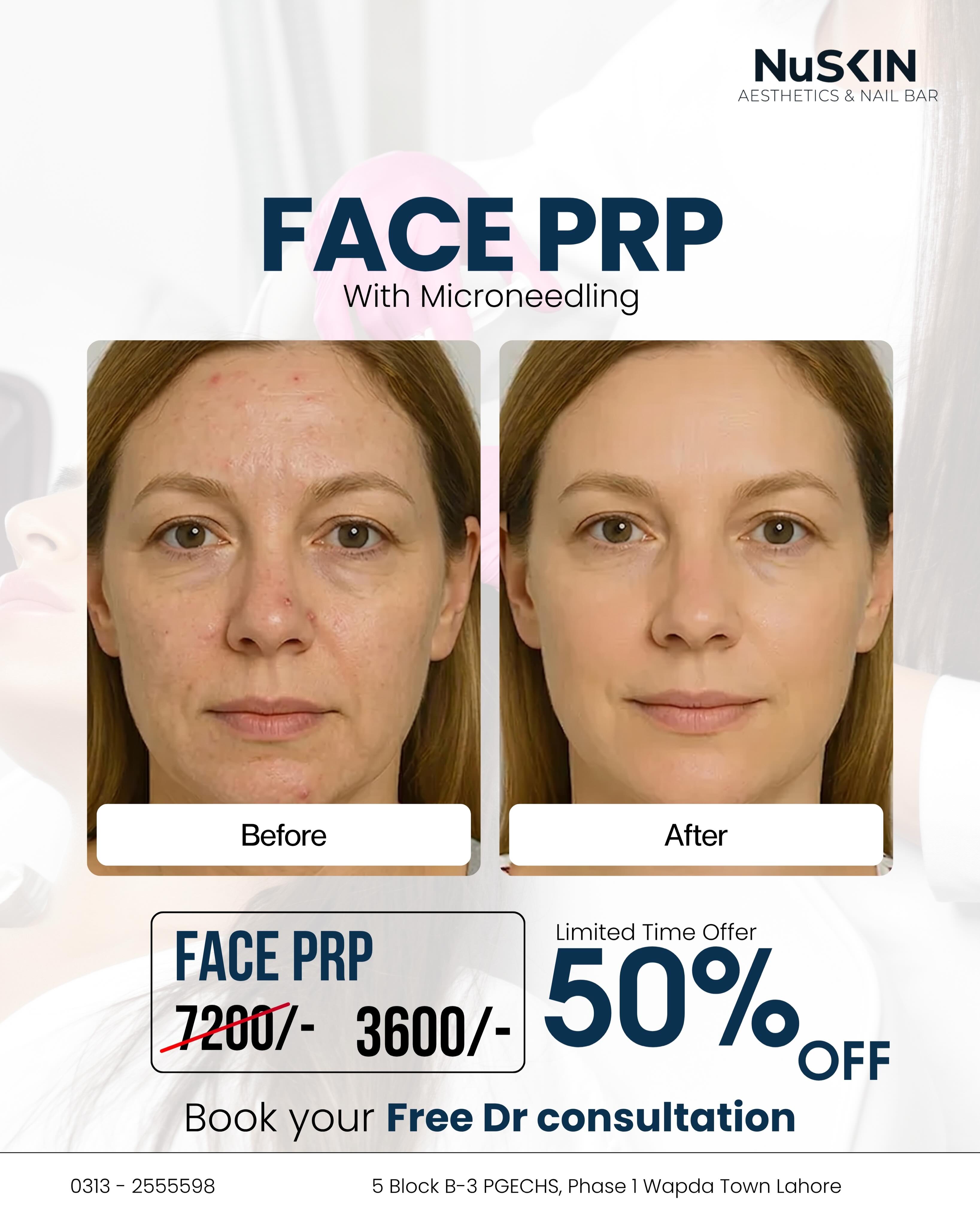 NuSkin Aesthetics & Nail Bar Facebook ad: Restore Your Glow Naturally with PRP Treatment