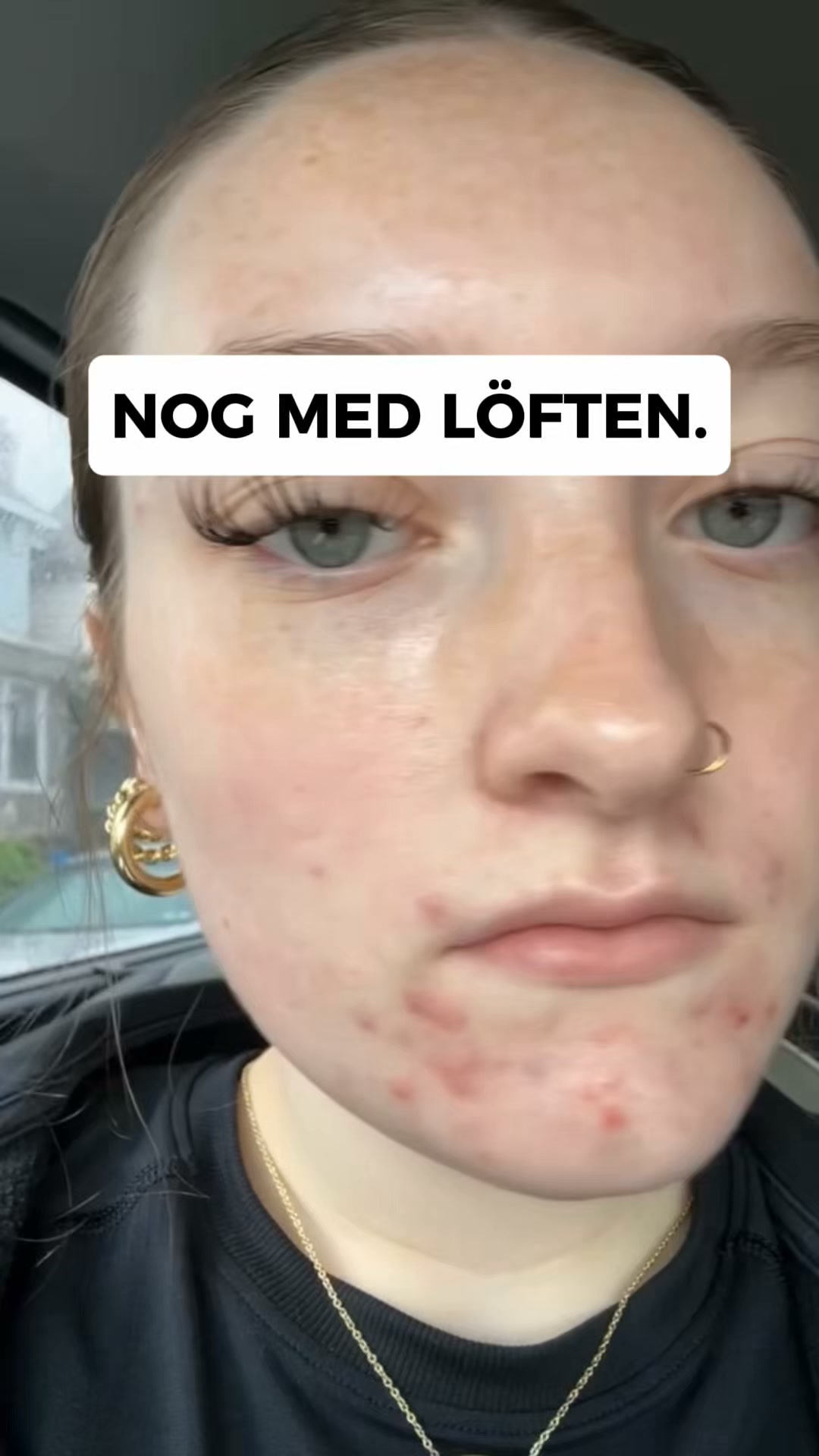 LovieBaby Facebook ad: Naturlig hudvård för akne