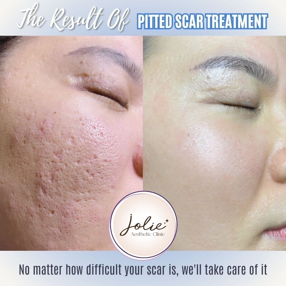 Jolie Ageless Beauty Johor Facebook ad: No matter how severe your acne scars are…