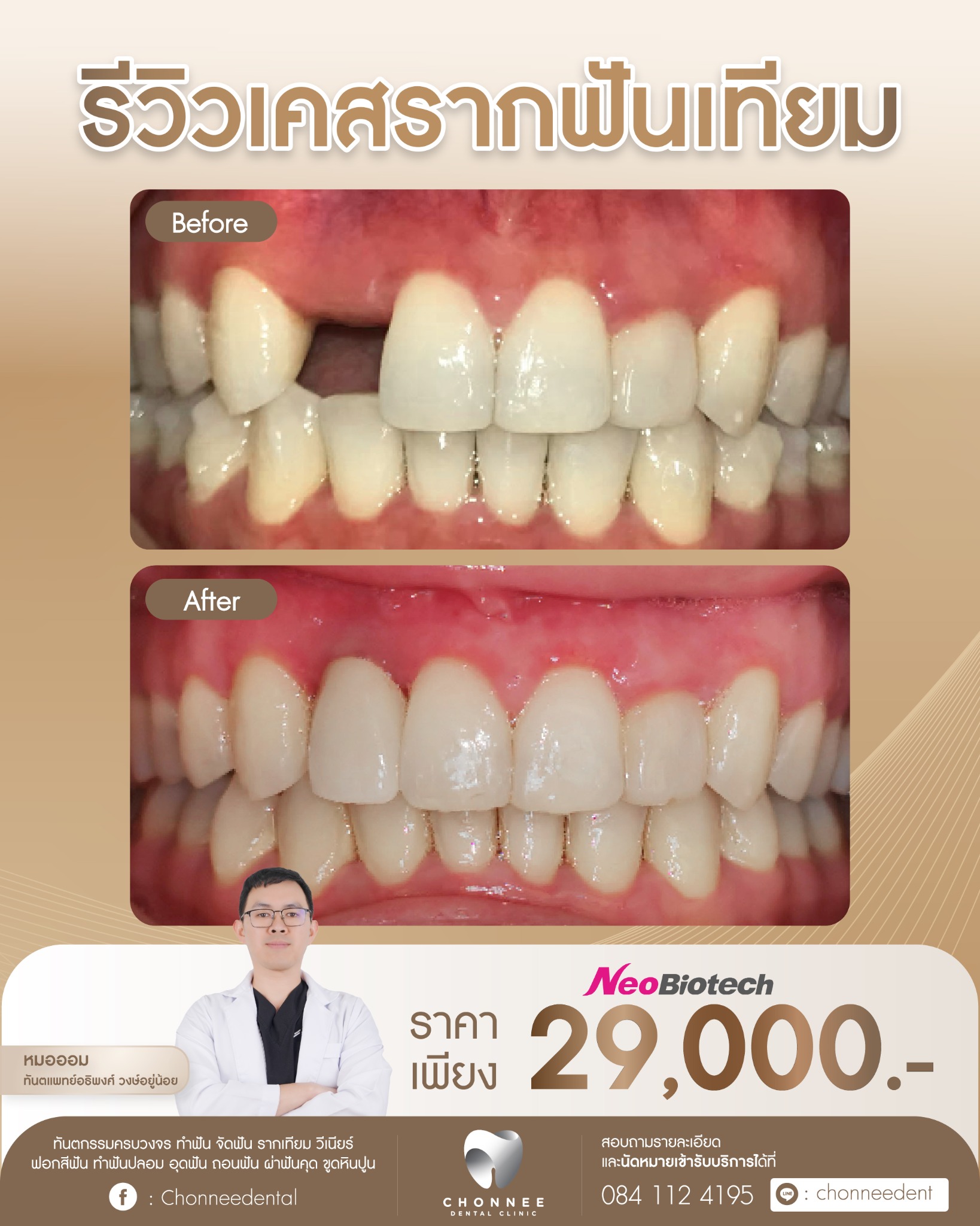 Chonnee Dental Clinic ทีมทันตแพทย์เฉพาะทางจัดฟัน รากฟันเทียม - ราชพฤกษ์ ตลิ่งชัน Facebook ad: รากฟันเทียม ราคาพิเศษ 29,000(รวมครอบฟัน) ปรึกษาฟรี!