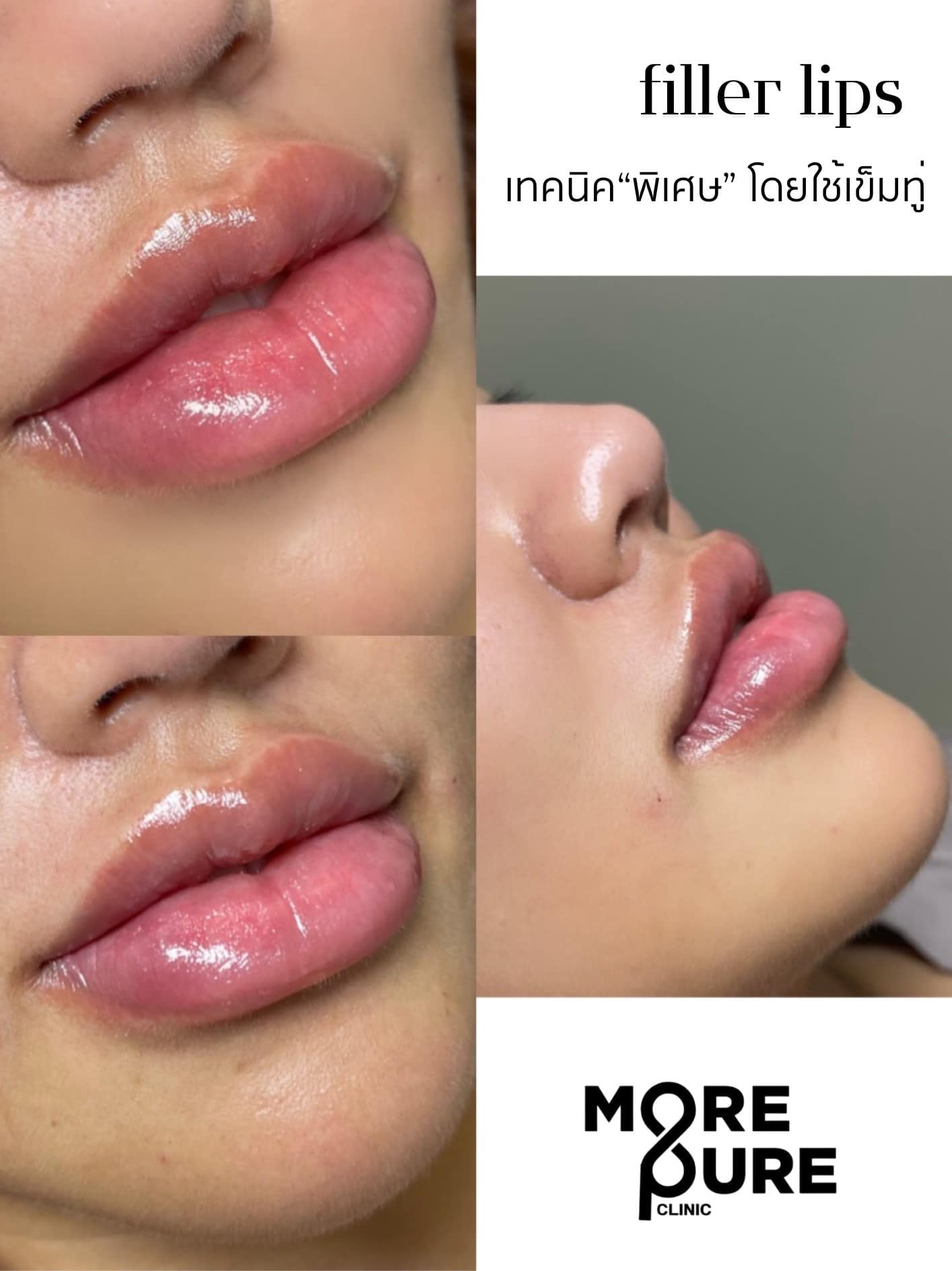 Morepure Clinic - หมอเพียวคลินิก ปรับรูปหน้า ปลูกผมภูเก็ต Facebook ad: รีวิว ฟิลเลอร์ปาก