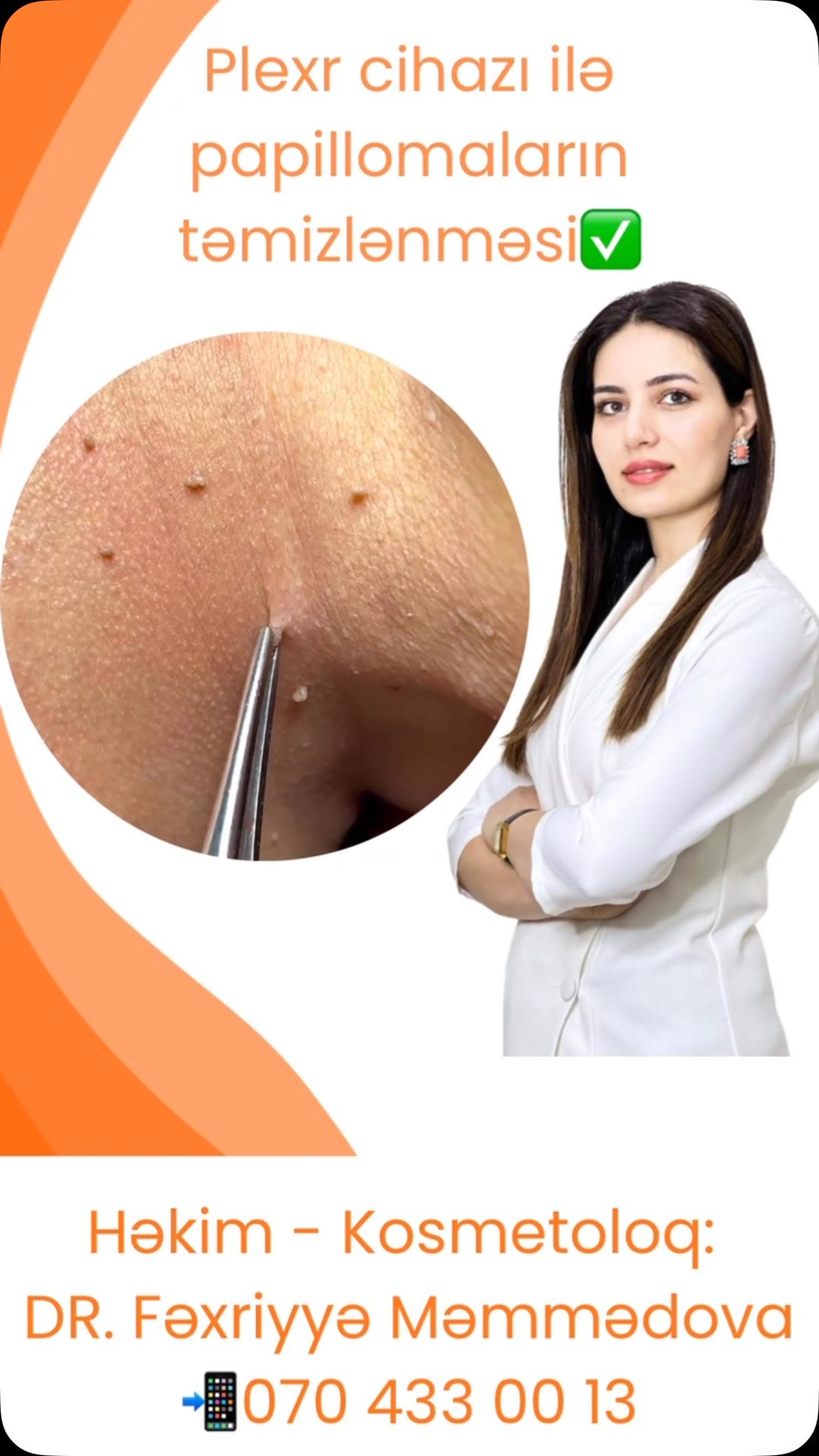 Dr.Fexriyye Fotona Lazer Facebook ad: Plexr cihazı ilə papillomaların aradan qaldırılması.