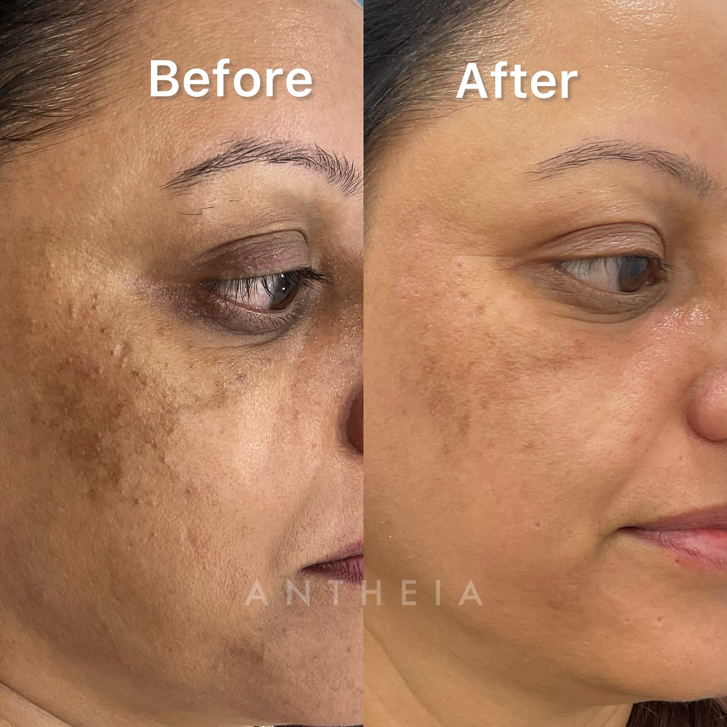 Antheia Aesthetics Facebook ad: Melasma hyperpigmentations treatment.