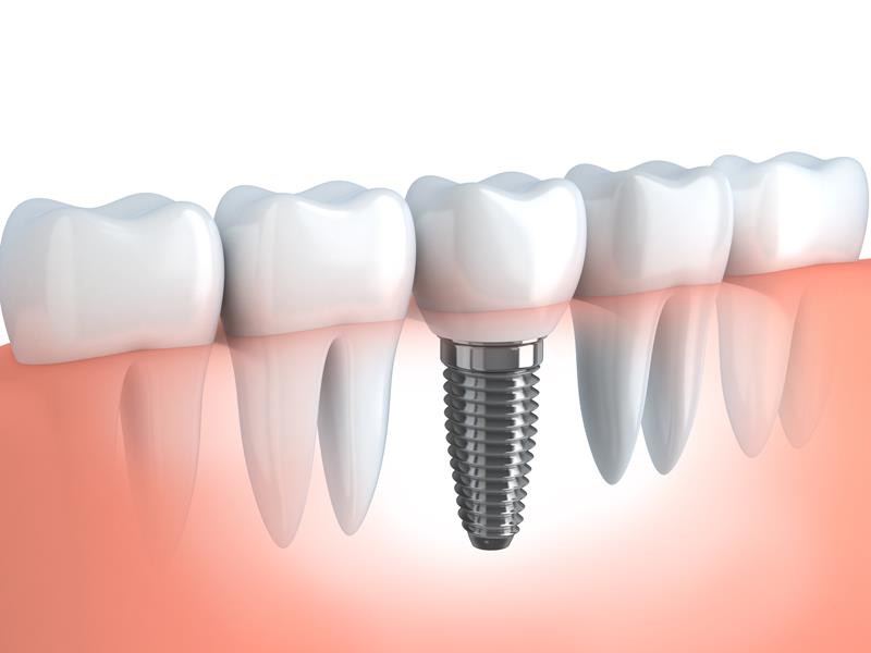 Tandartstoerisme in Valkenburg / NL Facebook ad: Dental implants va 650,-