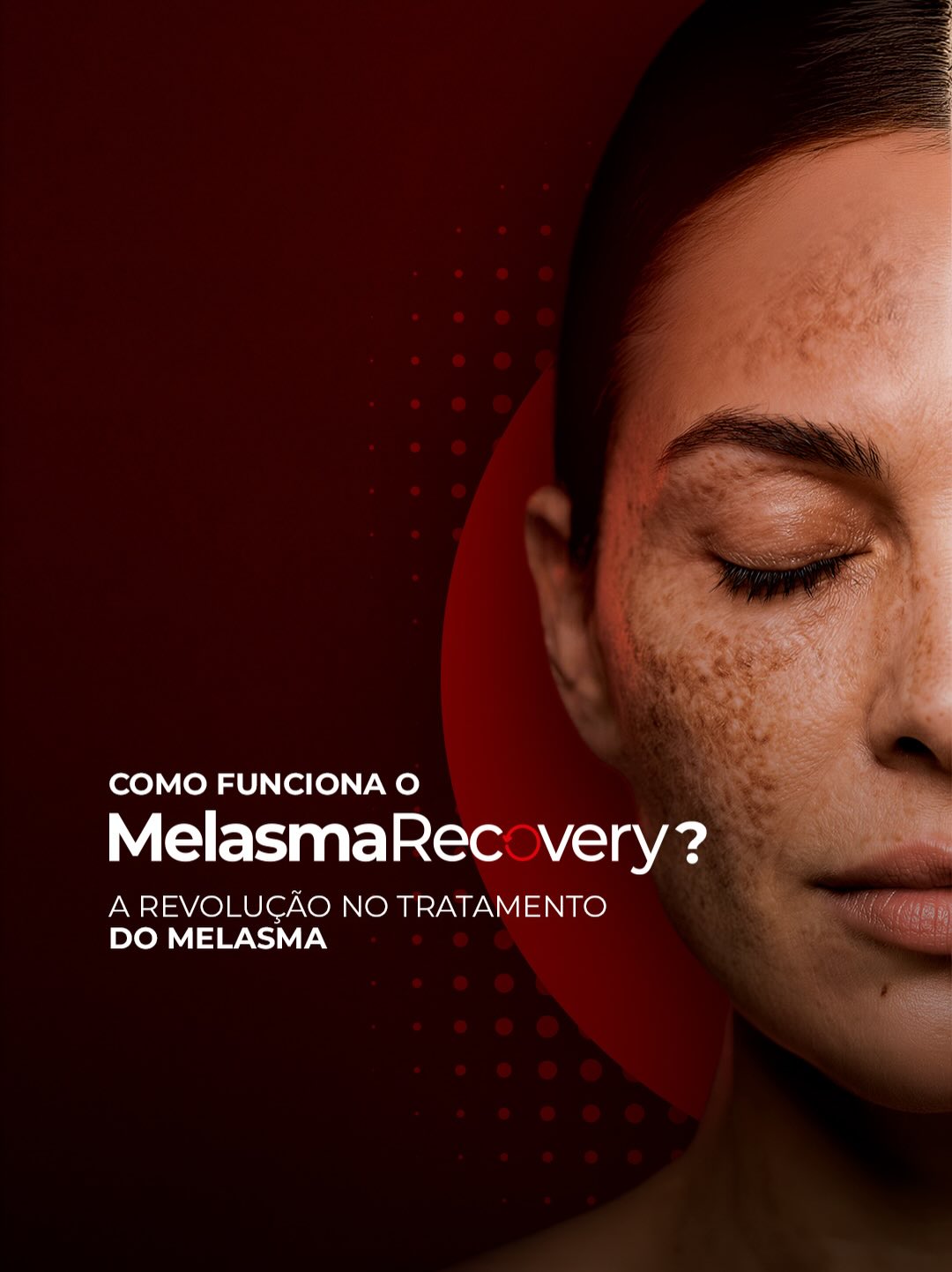 Fotona Laser - Dermatologia Facebook ad: MelasmaRecovery: um protocolo desenolvido para…