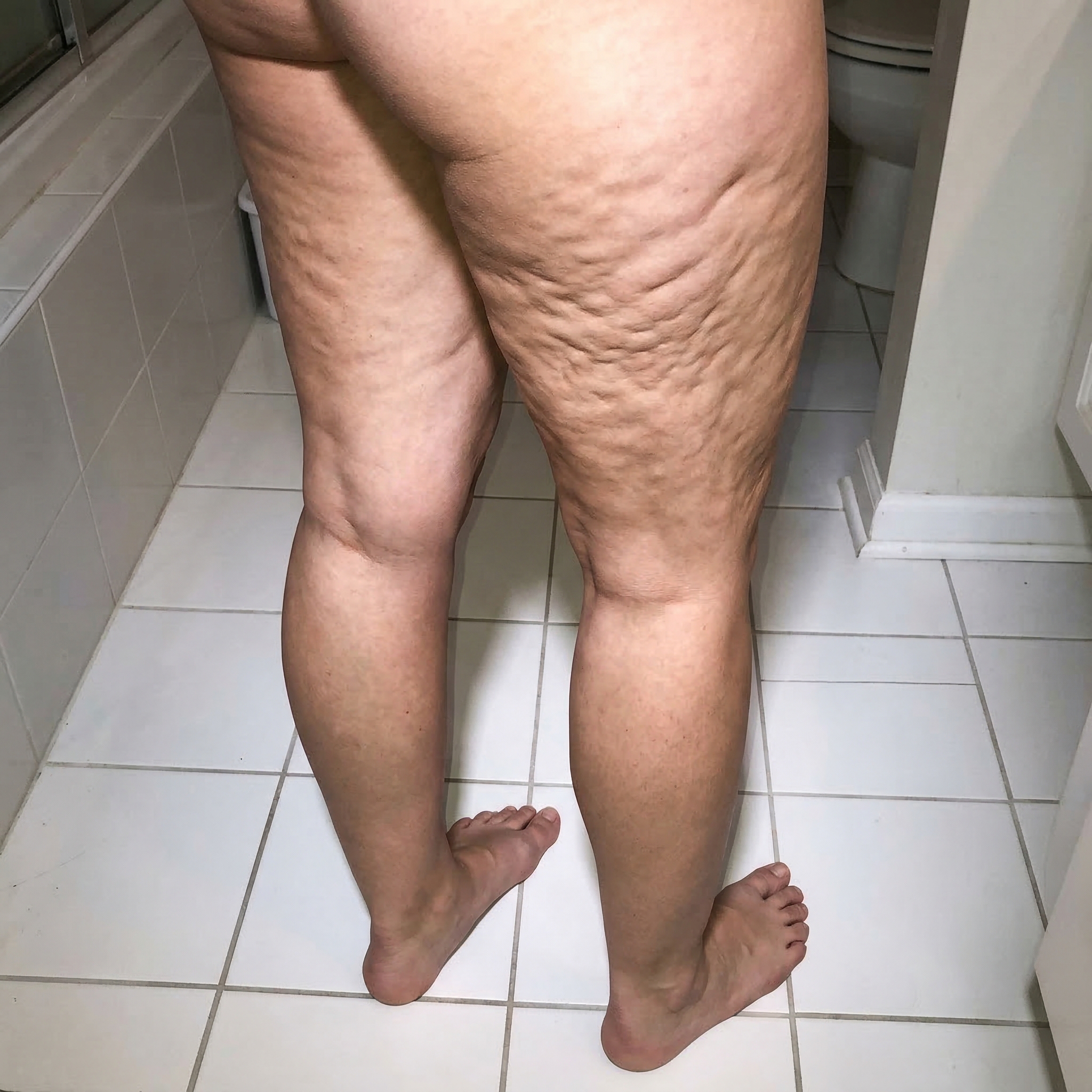 Susan Miller Facebook ad: I've Been Hiding My Legs For 3 Years.