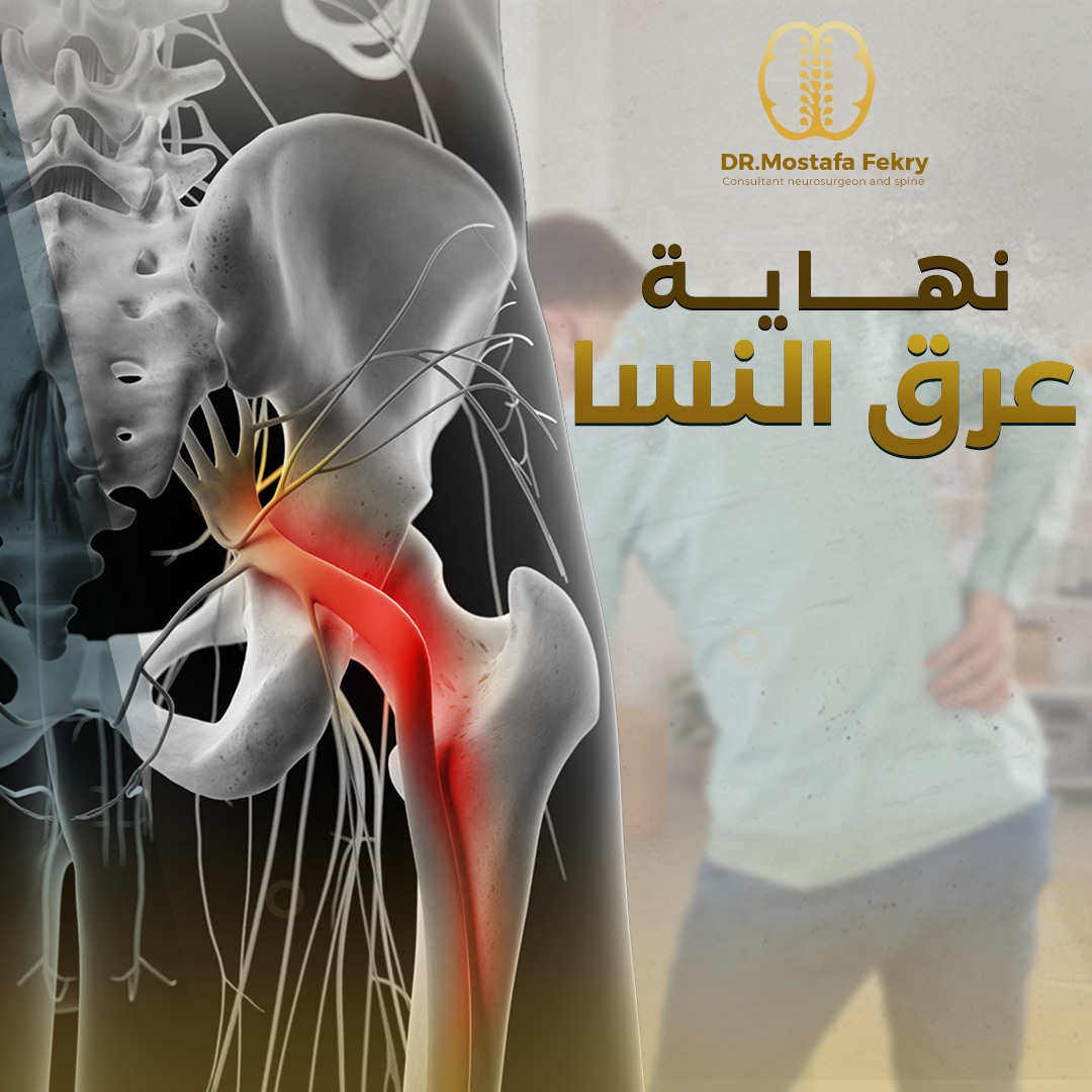 دكتور مصطفى فكري طنطاوي استشاري جراحة المخ والأعصاب والعمود الفقري Facebook ad: عــرق النســا من الأمـــراض المنتشرة عشان كدة متسكـتش…