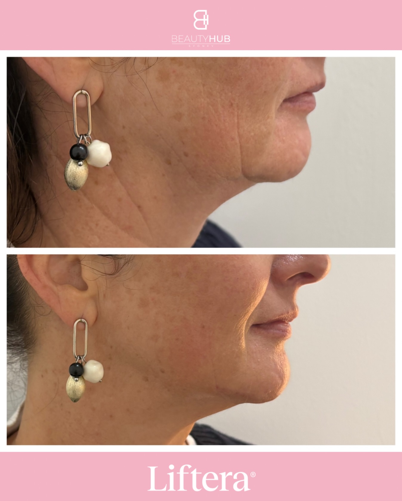 Beauty Hub Sydney Facebook ad: HIFU Sydney | Non-Surgical Face & Body Lift | Beauty Hub…