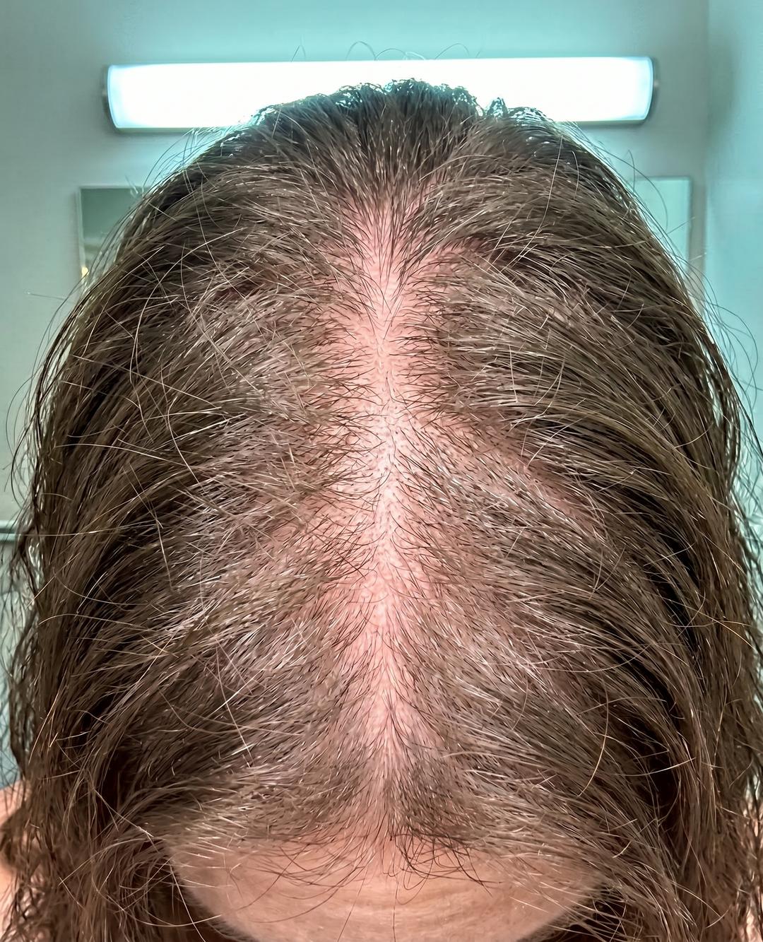Lynn Brown Facebook ad: Mounjaro Took My Hair →