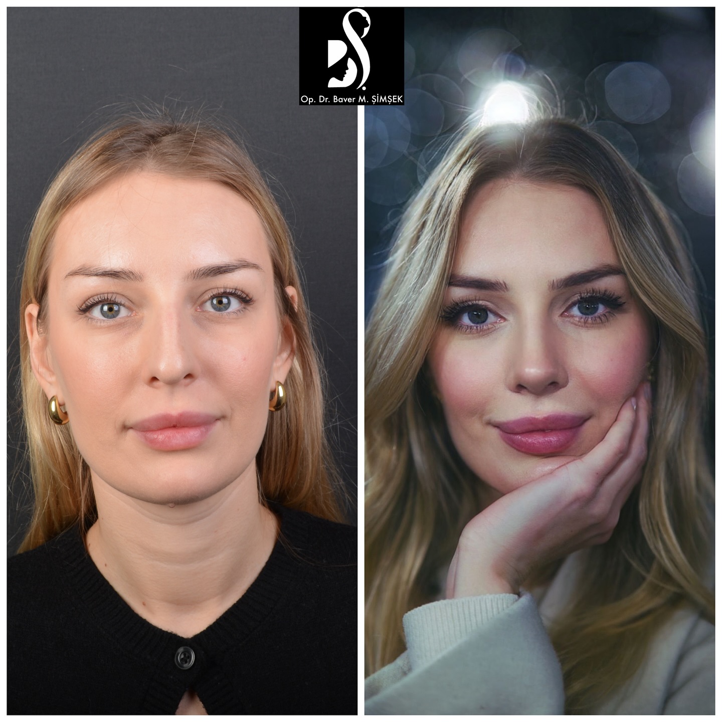 Op Dr Baver M. Şimşek Facebook ad: Early term result of my beautiful patient