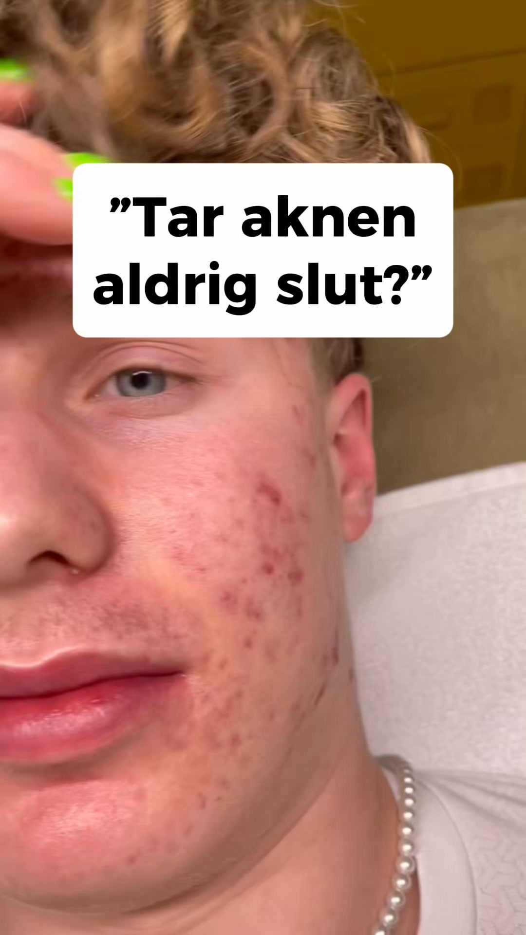 LovieBaby Facebook ad: Naturlig hudvård för akne