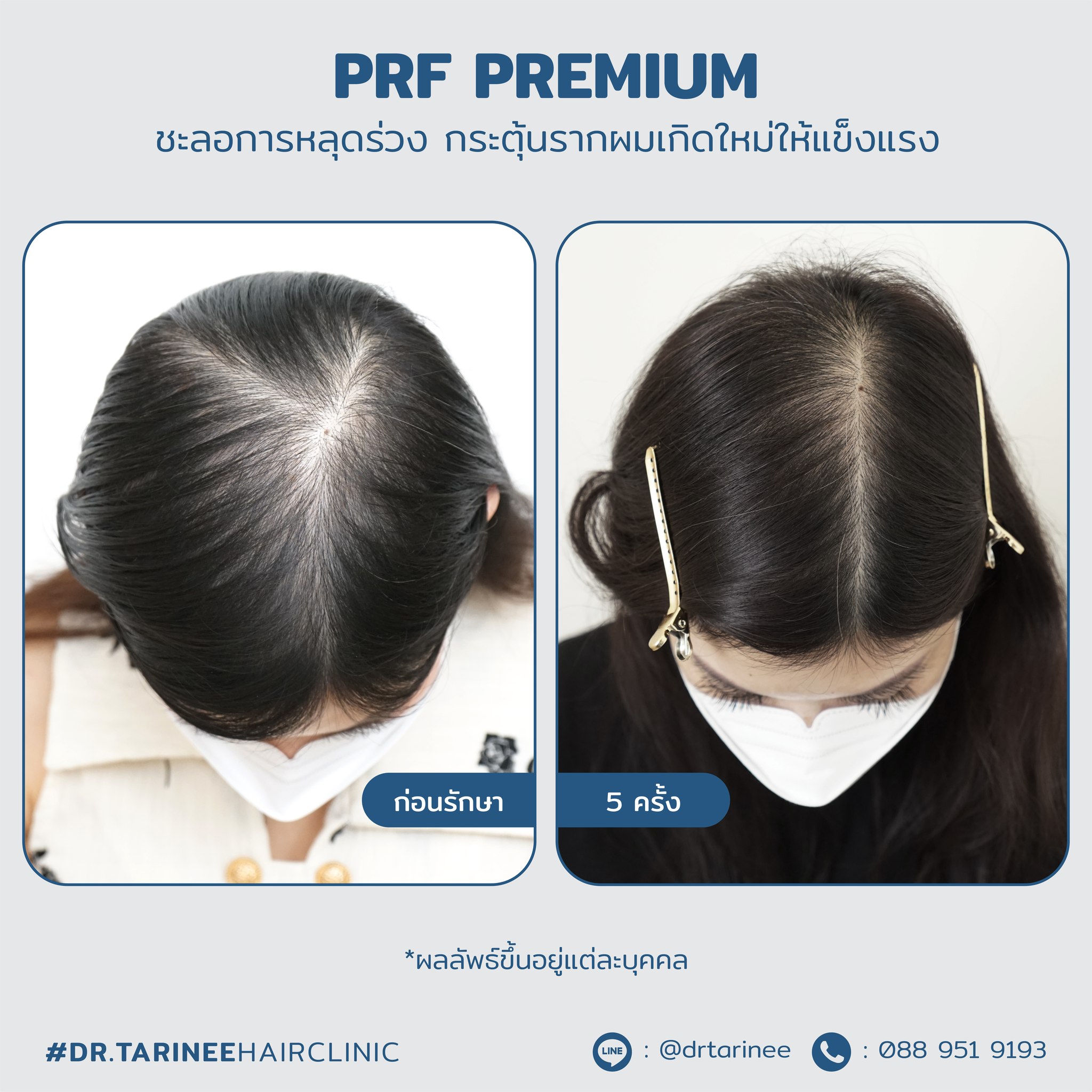 Dr.Tarinee Hair Clinic ปลูกผม รักษา ผมร่วง ผมบาง Facebook ad: นวัตกรรมรักษาผมร่วง ผมบาง รากผมอ่อนแอ…