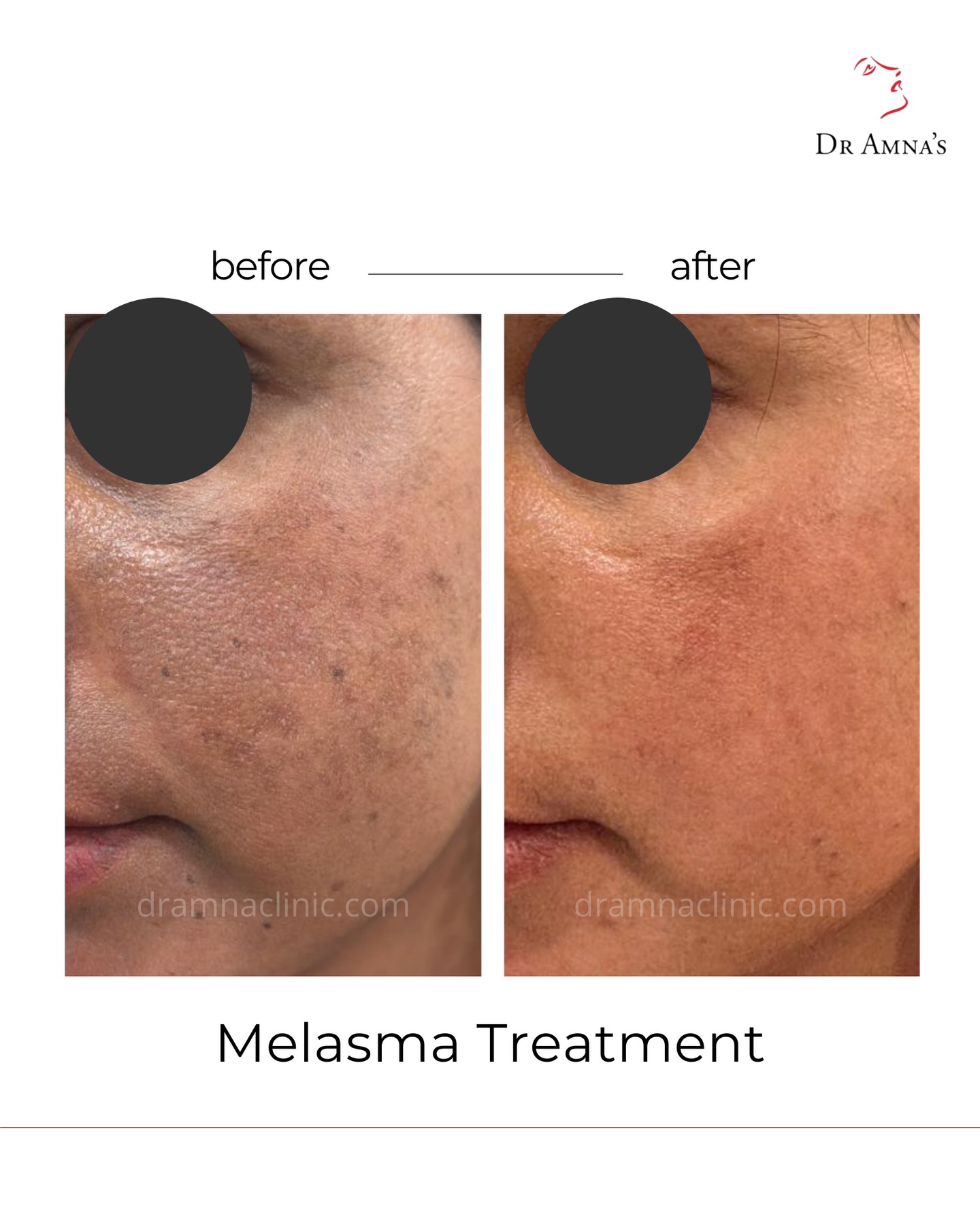 Dr. Amna's Skin Clinics Facebook ad: These results speak louder than any promise we…