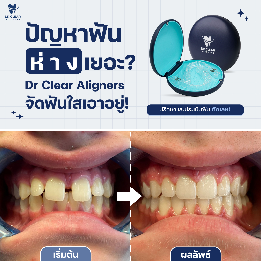 Dr Clear Aligners Thailand Facebook ad