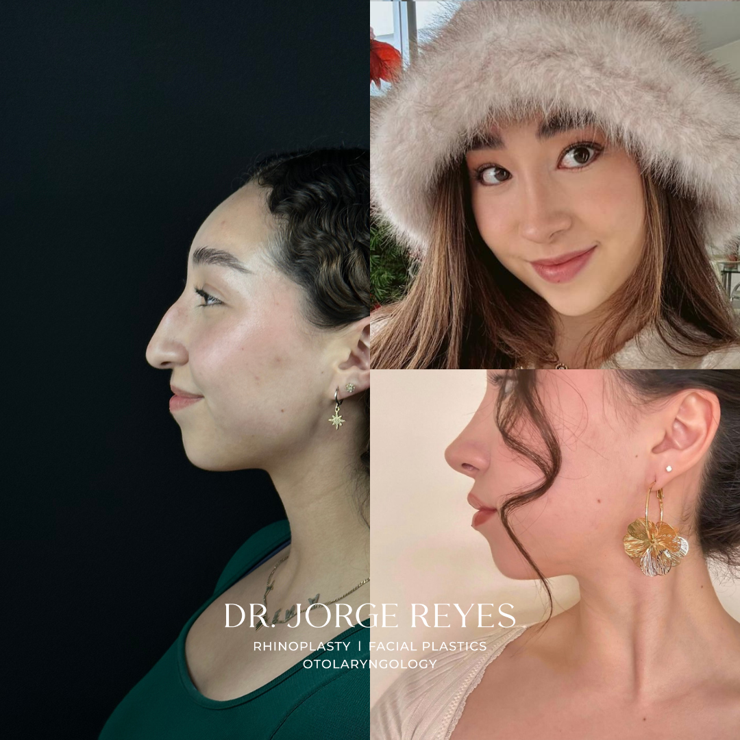 dr.jreyes_otorrino Facebook ad: Tu rinoplastia reflejará lo que siempre estuvo en…