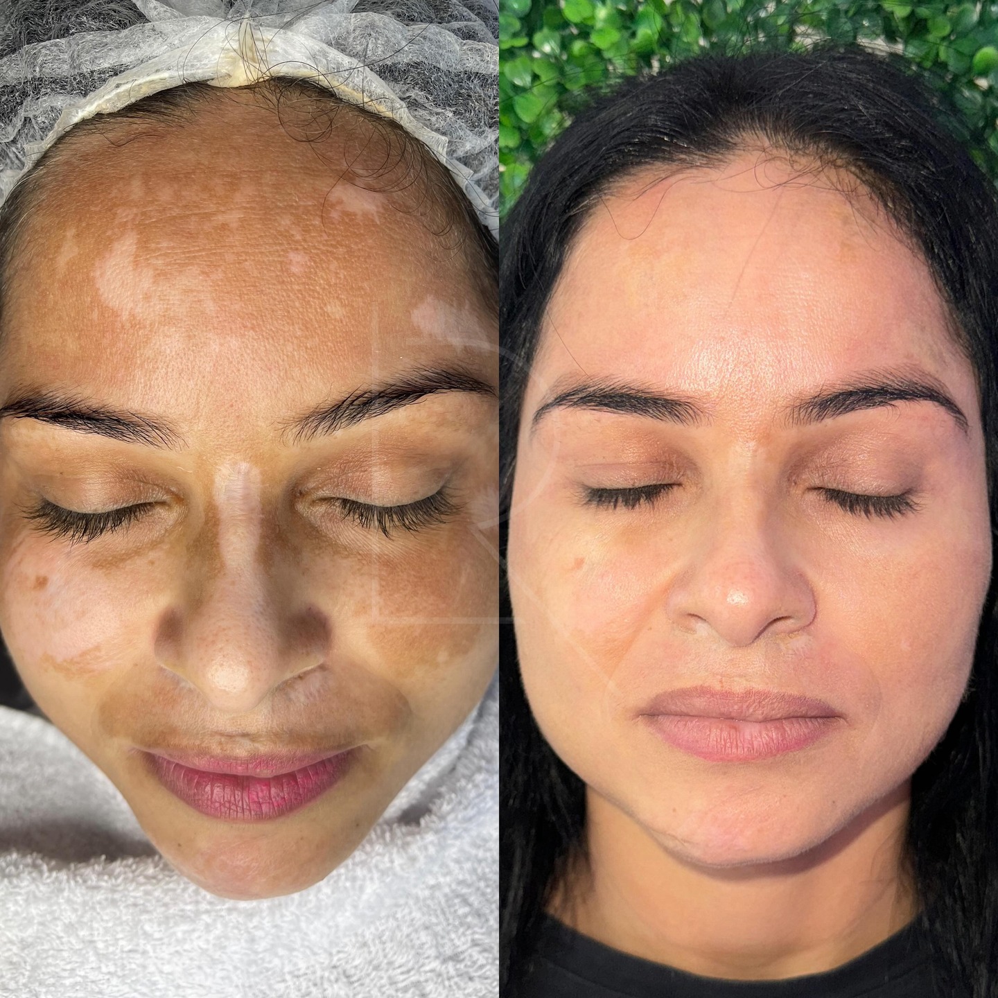 Luana Rodrigues Estética Facebook ad: Minha 1ª paciente do Método Melasma Care aqui…
