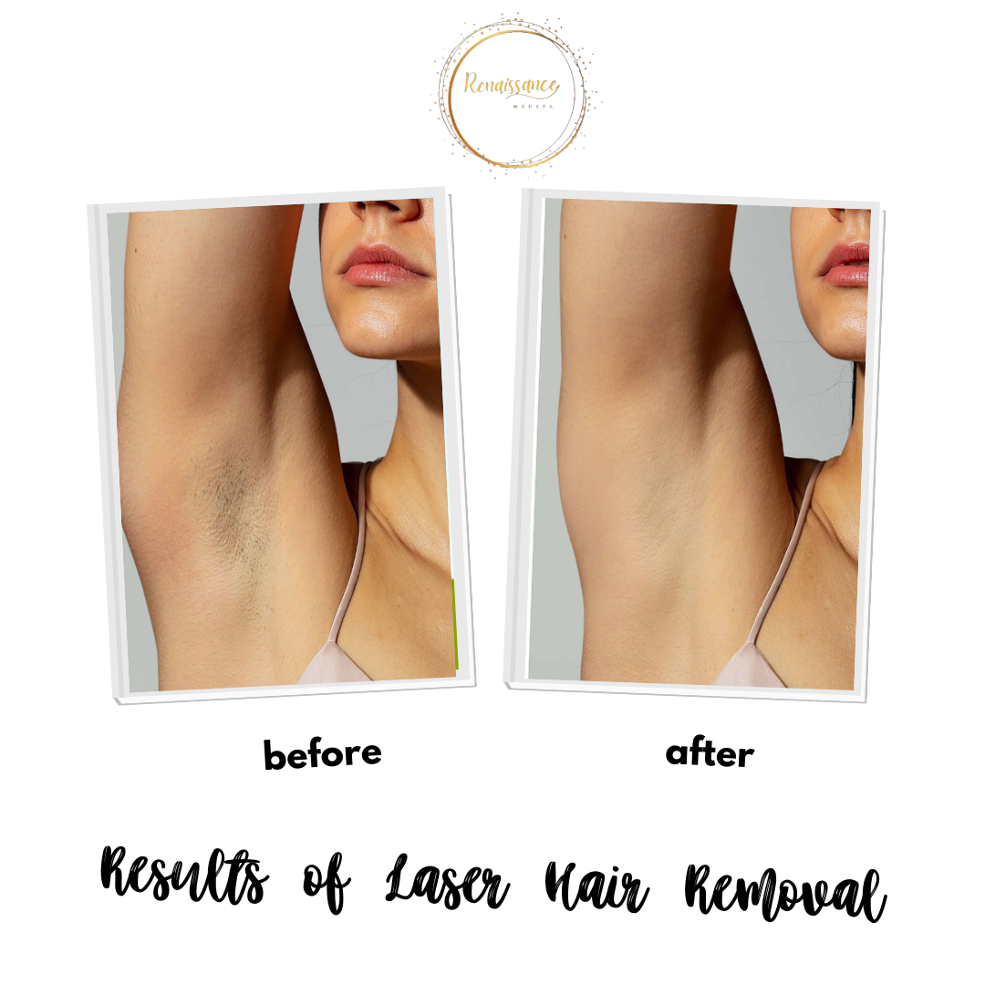 Renaissance med spa Facebook ad: Unlimited Laser Hair Removal, 1 Year for $250