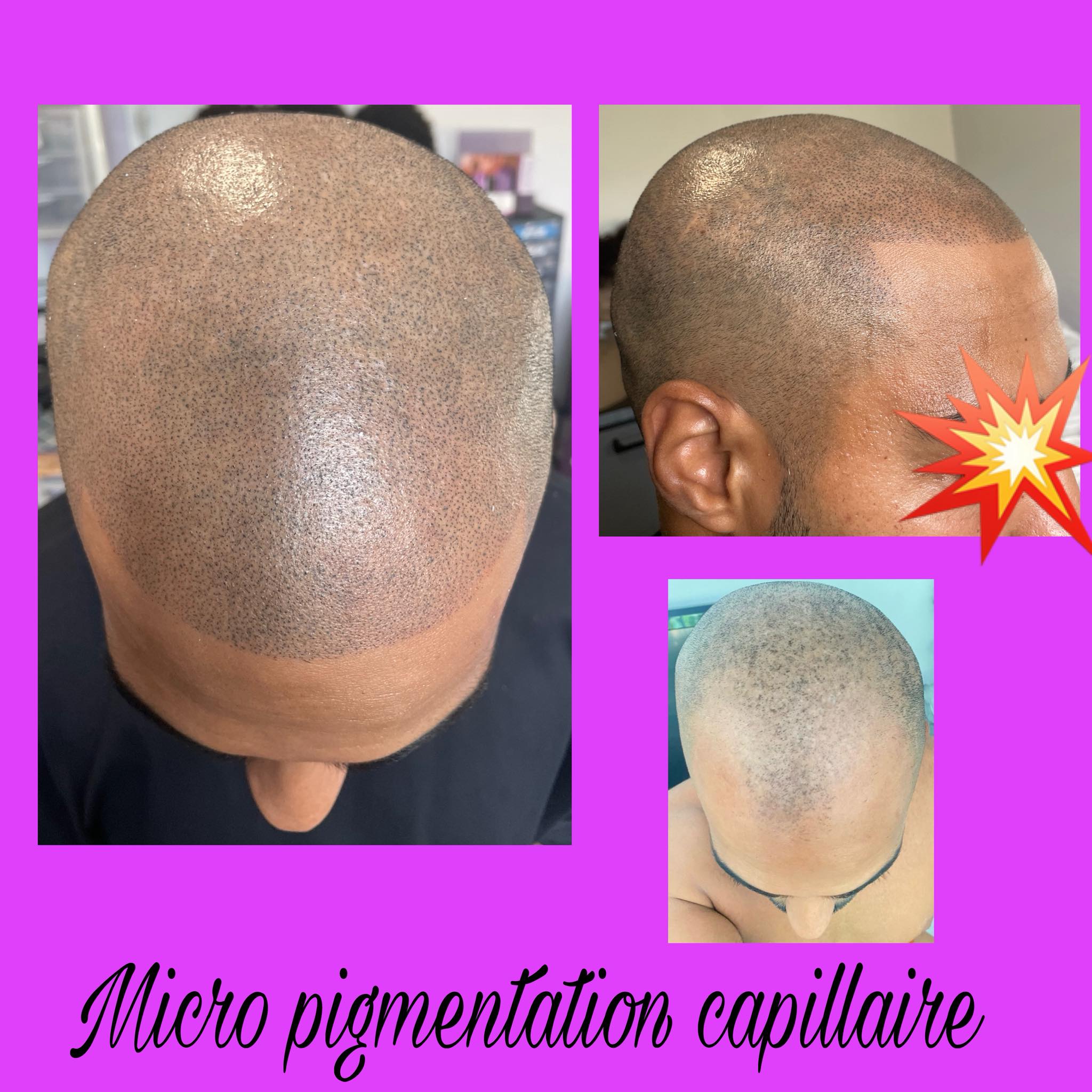 Nouvel Hair Clinic Facebook ad: Calvitie, alopécies ou perte de densité capillaire?