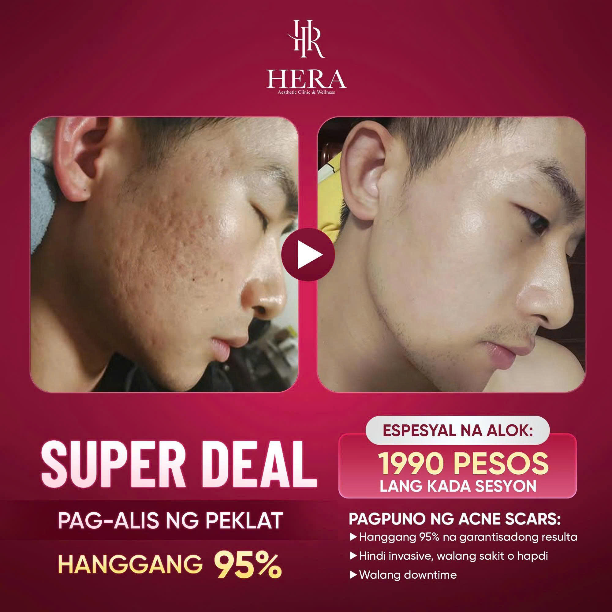 Hera Aesthetic Clinic Facebook ad: BAKIT MAS LUMALALA ANG SCARS KAHIT ANG DAMI…