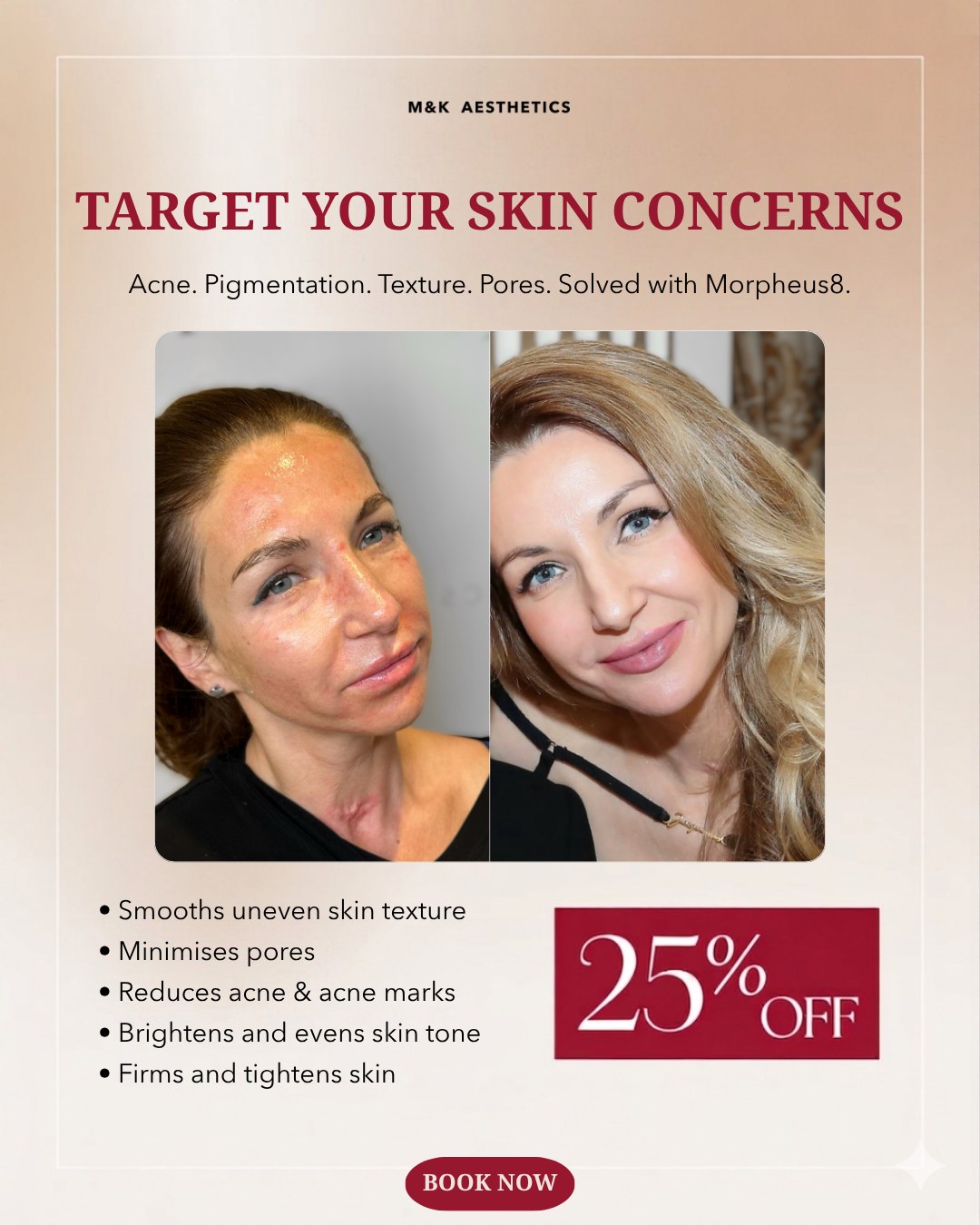 M&K Aesthetics Facebook ad: 25% OFF Morpheus8, Reduce Scars, Pores & Wrinkles
