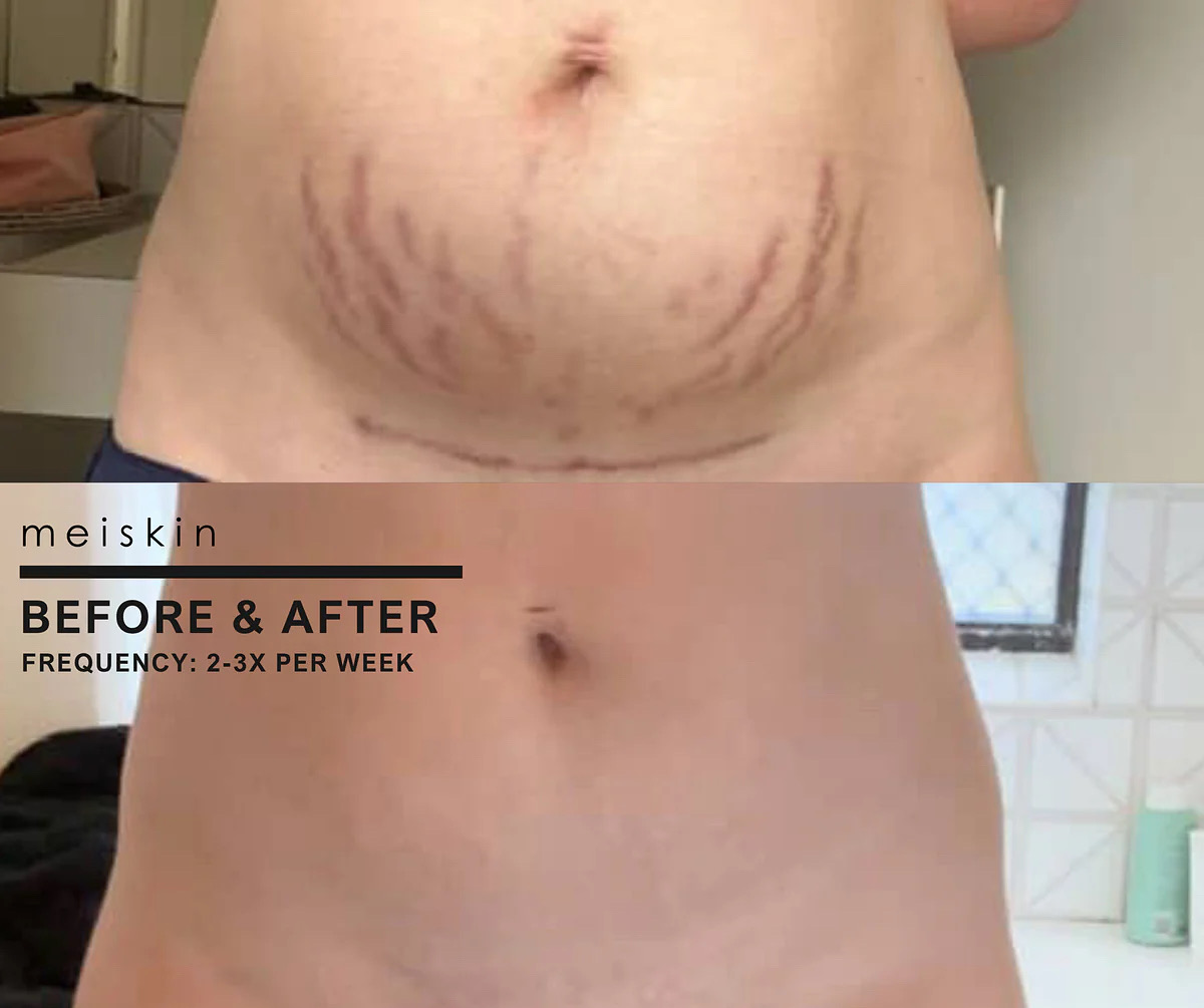 Meiskin - The Stretch Mark & Scar Treatment Oil Facebook ad from Mar 7, 2026