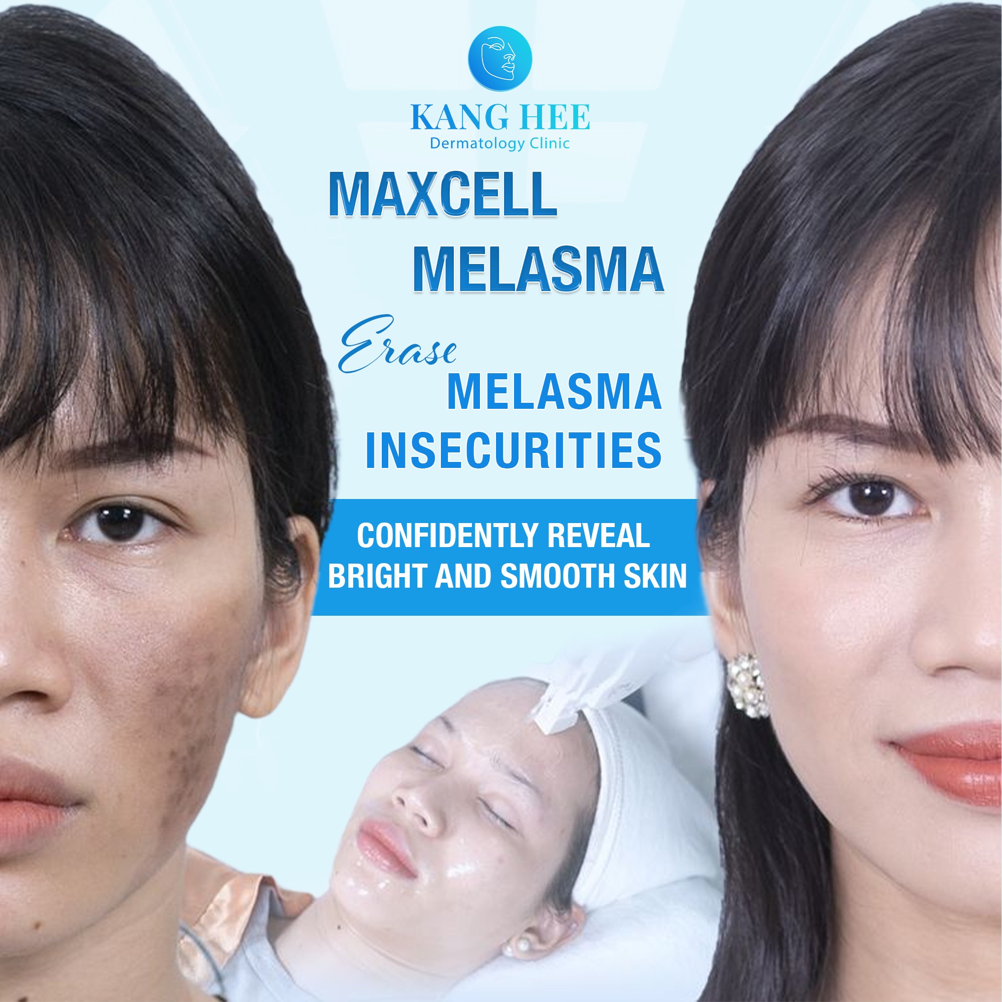 Kanghee Dermatology Clinic UAE Facebook ad: MAXCELL MELASMA, SAY GOODBYE TO PERSISTENT PIGMENTATION