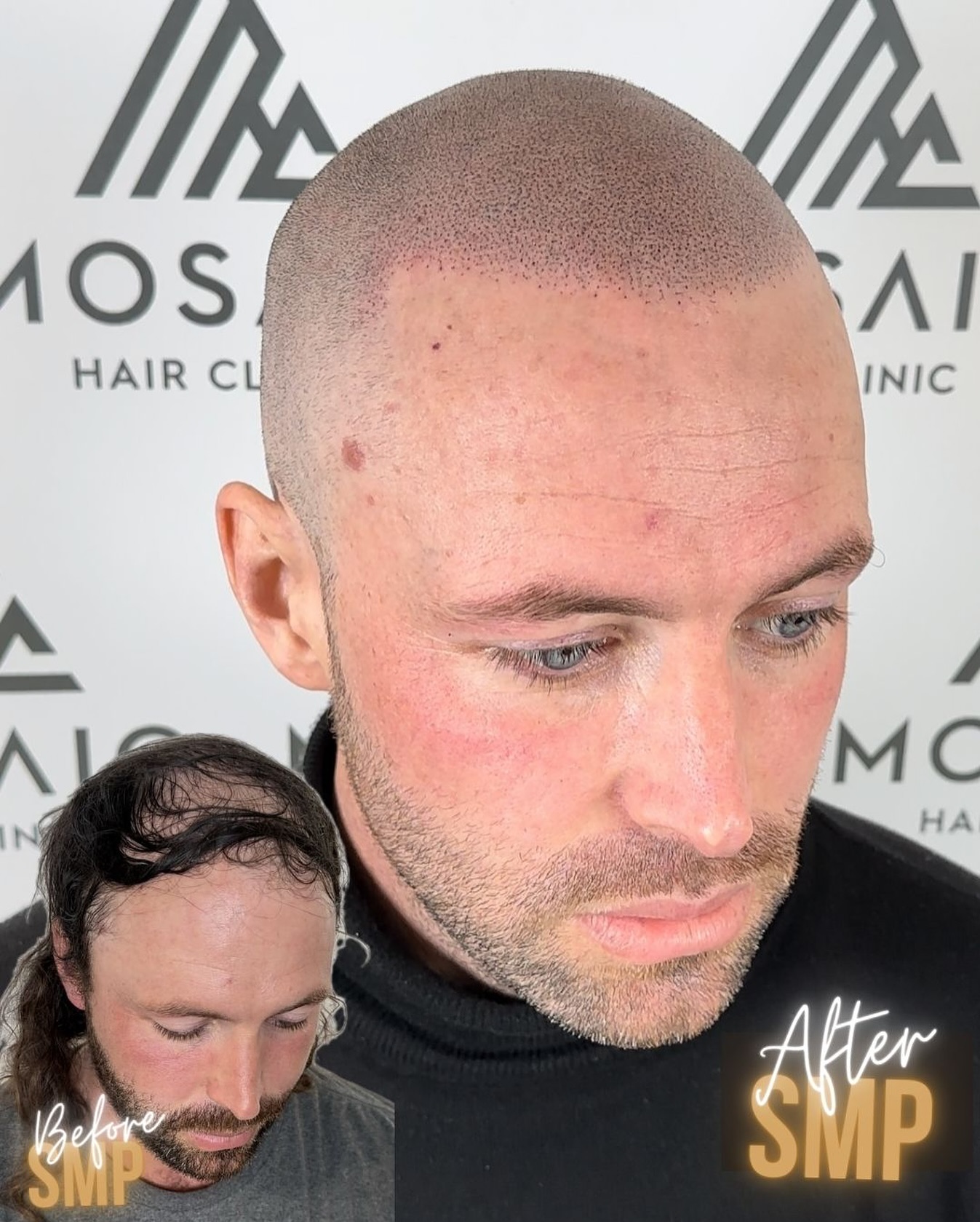 Mosaic Scalp Micropigmentation - UK Facebook ad: 𝑬𝒅𝒊𝒇𝒊𝒄𝒂𝒕𝒊𝒐𝒏 𝒃𝒆𝒄𝒌𝒄𝒐𝒏𝒔, 𝑹𝒚𝒂𝒏