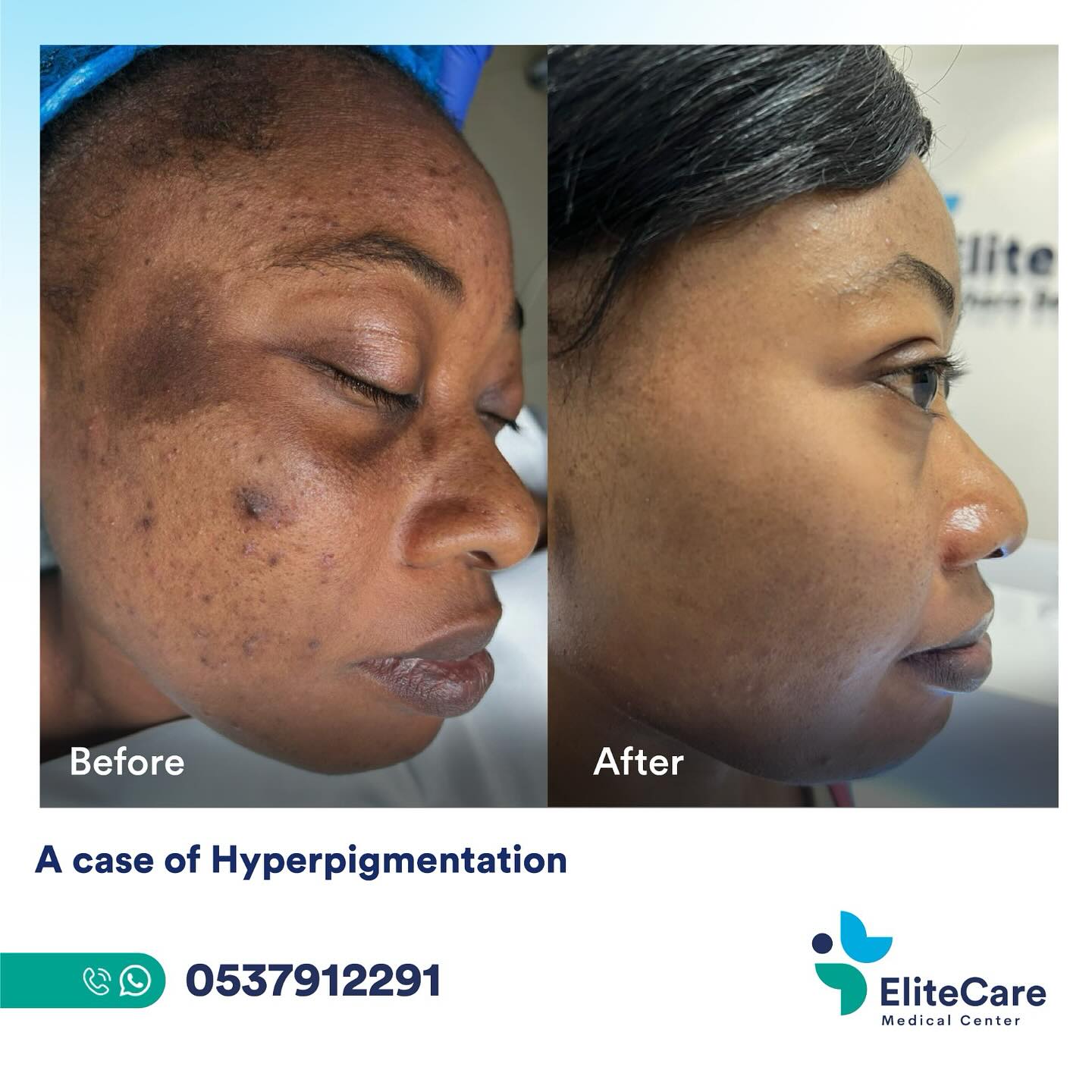 EliteCare Medical Center Facebook ad: Severe Acne with Post-Inflammatory Hyperpigmentation…