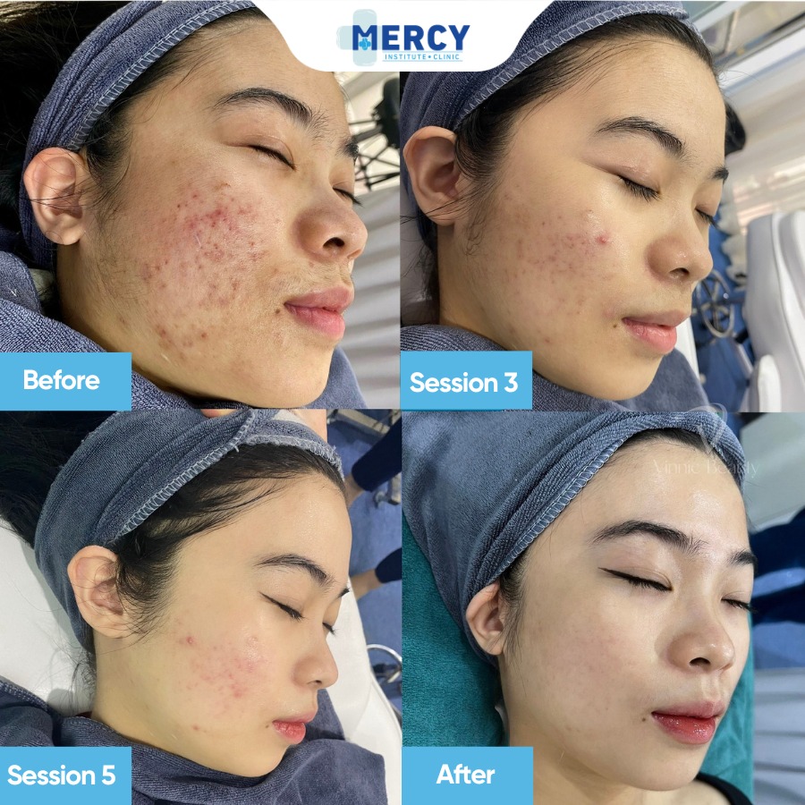 Mercy Acne & Skin Clinic in the Davao Facebook ad