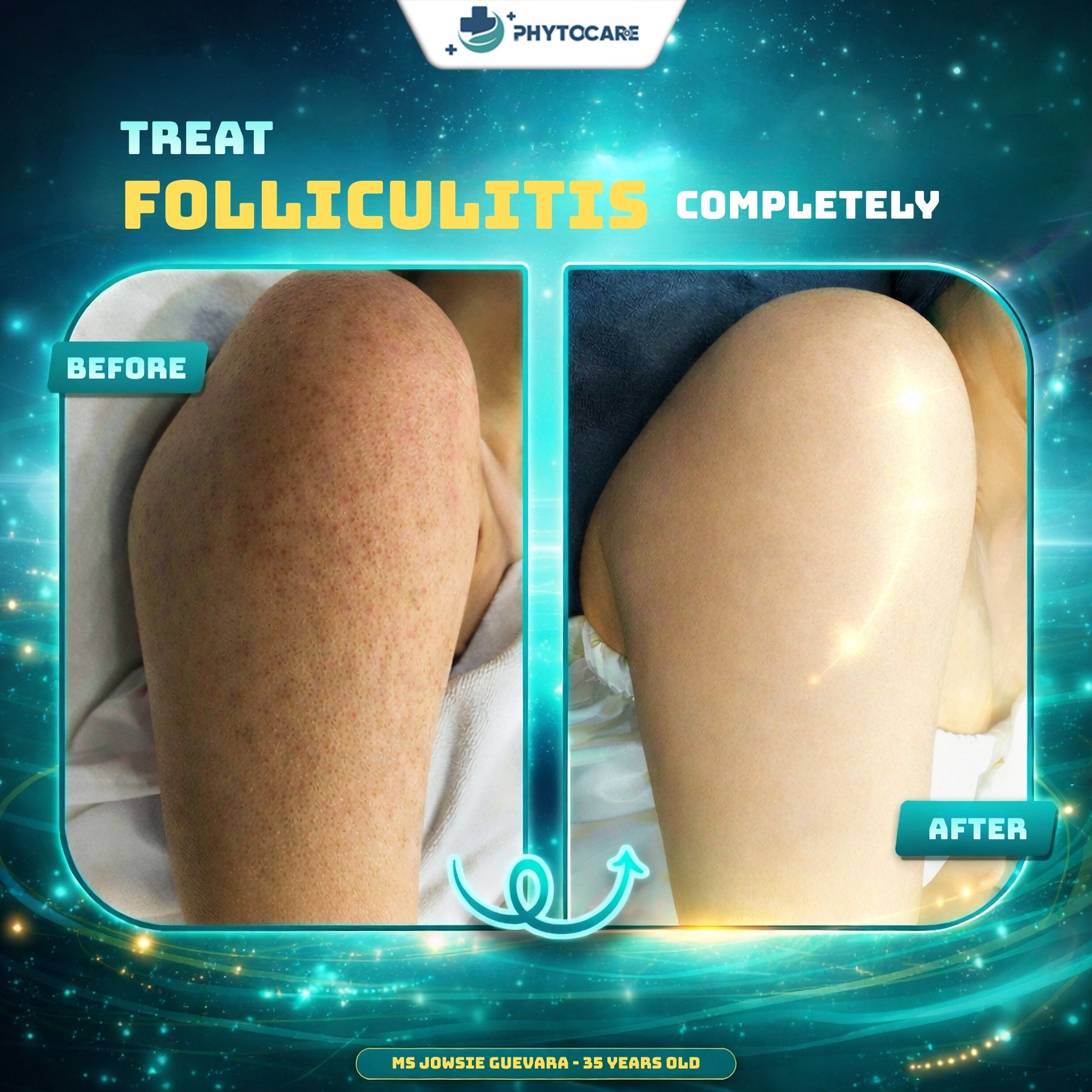 Phytocare DermaFolli Clinic Davao Facebook ad: SMOOTH ARMS - BRIGHT SKIN - CONFIDENTLY WEAR…