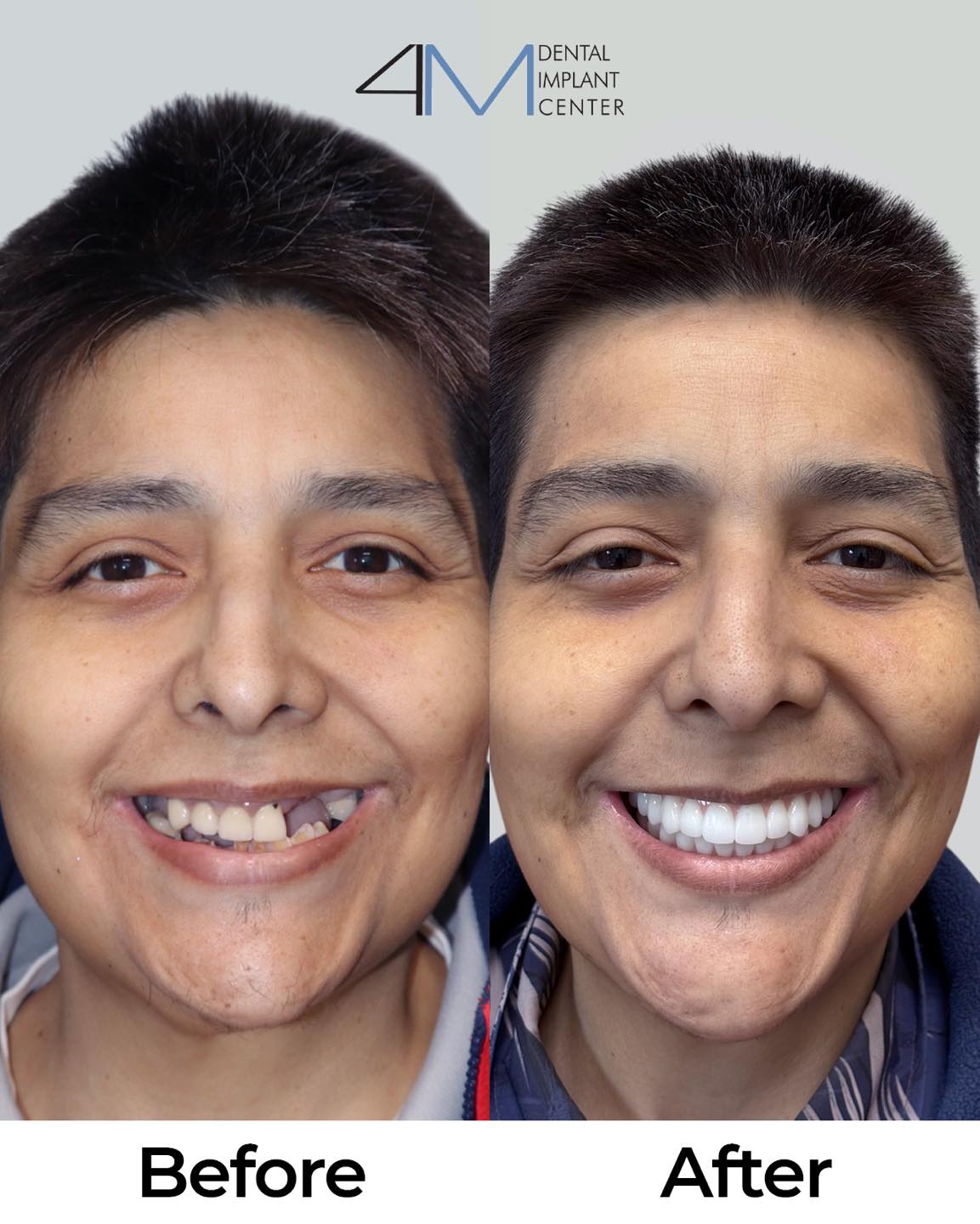 4M Dental Implant Center Facebook ad: Cases like this remind us why we love…