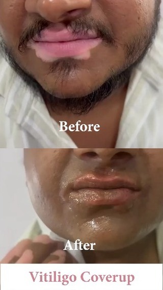 vitiligo and strech mark solution Facebook ad: Vitiligo Cover-up and Micropigmentation results