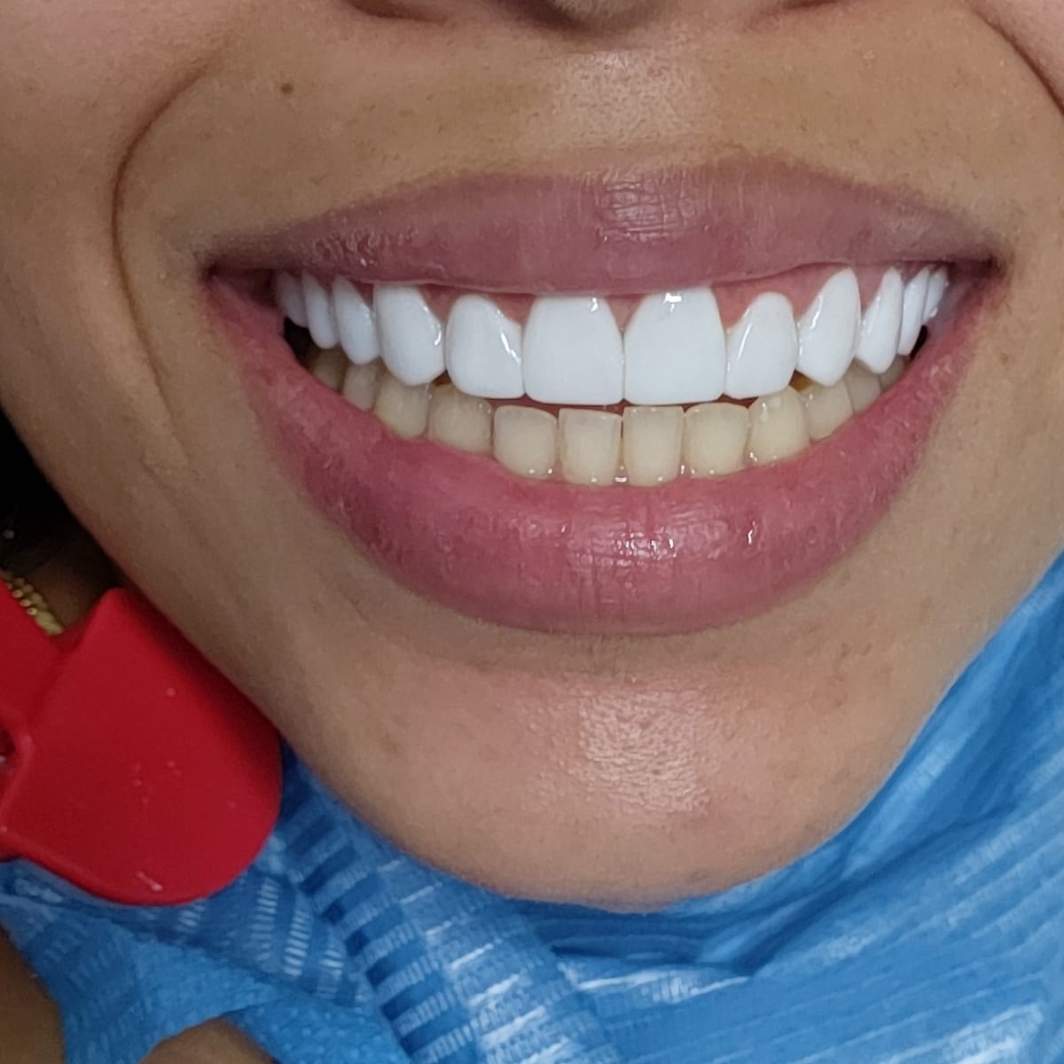 Clinica Dental Condesa Facebook ad: Carillas de resina 50%