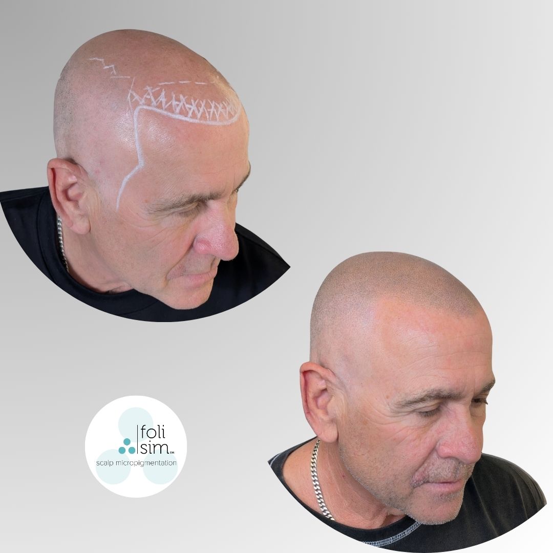 Foli Sim SMP Facebook ad: Are you struggling with hair loss in Melbourne?