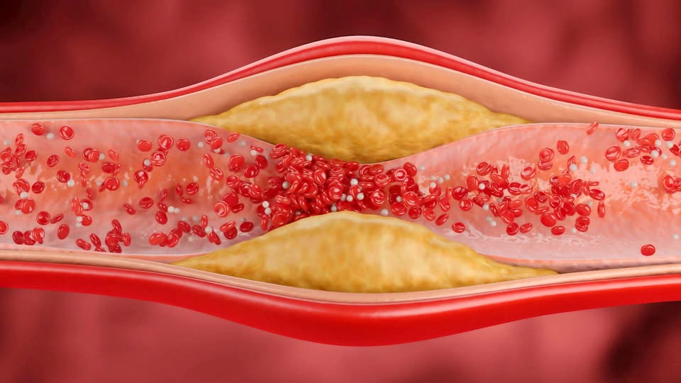 Advanced Sonography Screening Facebook ad: Hidden Plaque? Find Out