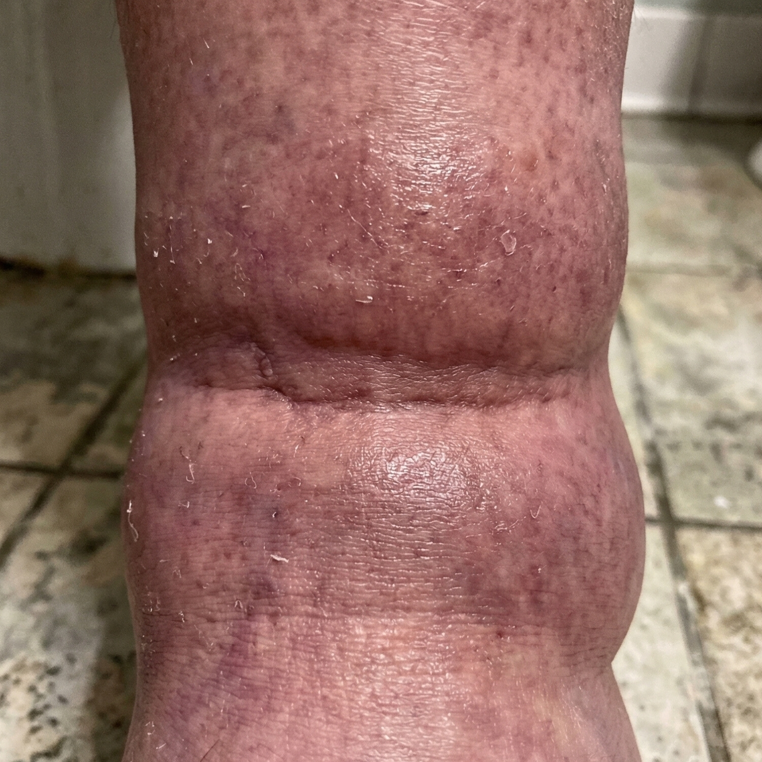 Inditropic Facebook ad: If Your Ankles Look Like This, Stop Wearing Compression…