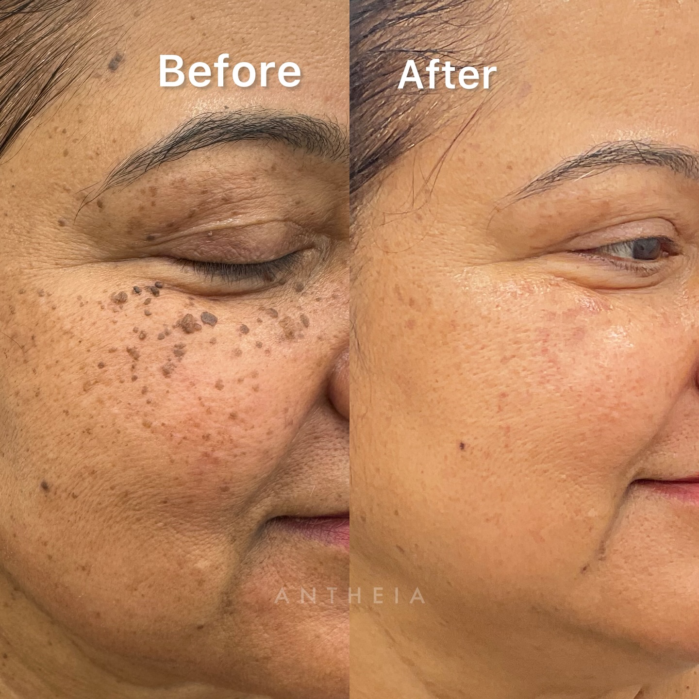 Antheia Aesthetics Facebook ad: FRECKLES REMOVAL.