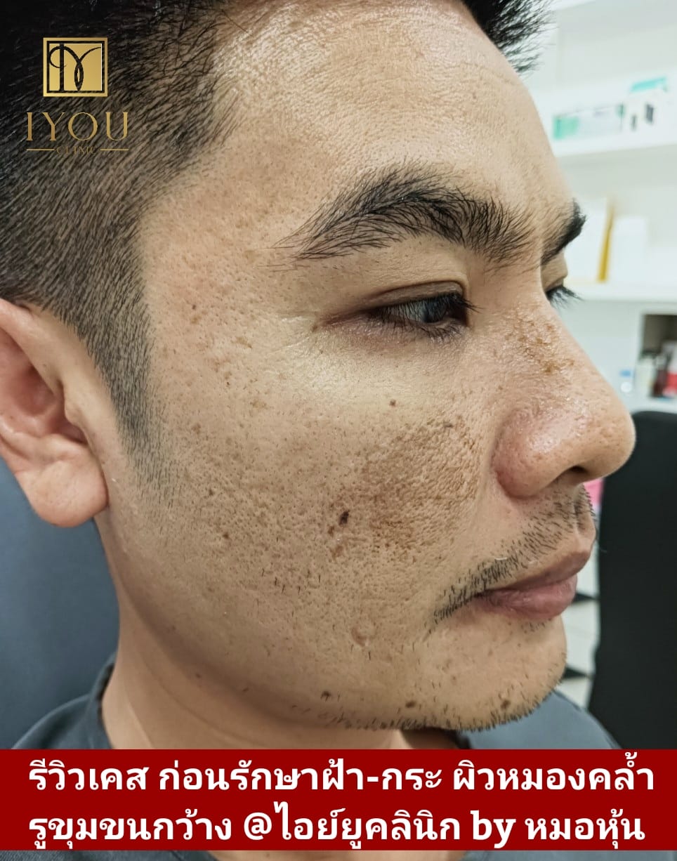 IYOU Clinic ไอย์ยูคลินิก ฉะเชิงเทรา by หมอหุ้น Facebook ad