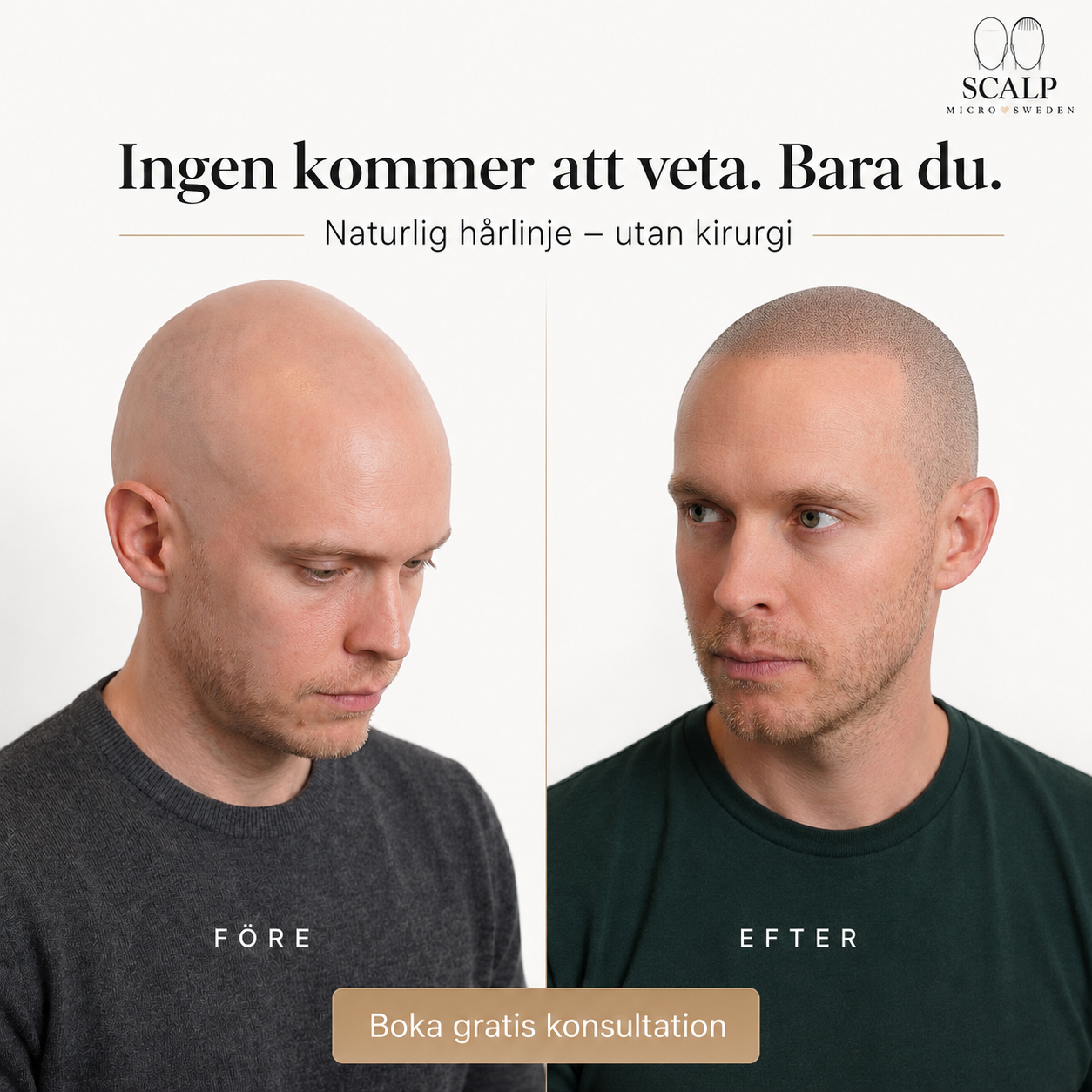 Scalp Micro Sweden SE Facebook ad: Boka din gratis konsultation