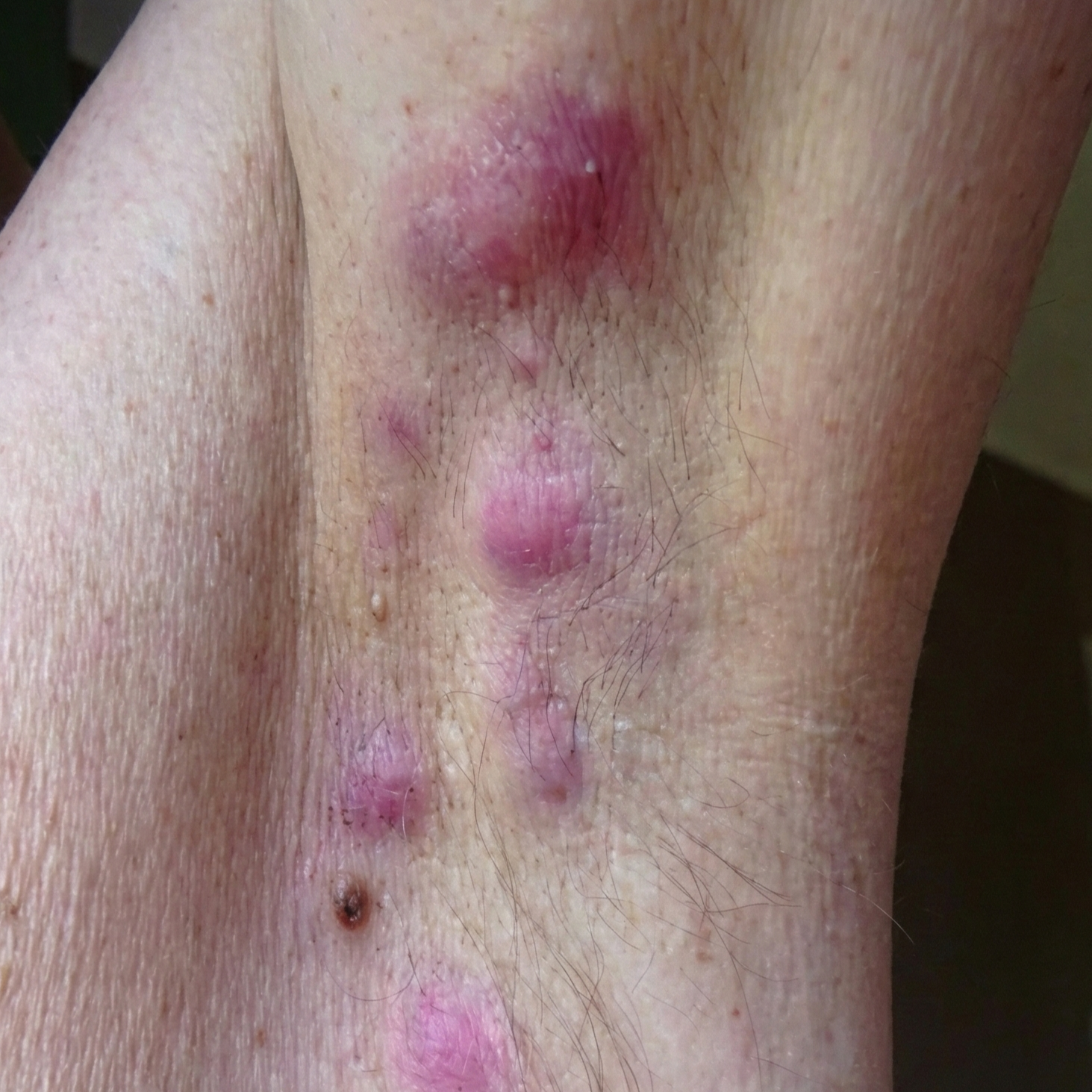 Sarah Brown Facebook ad: Read If You Suffer From Hidradenitis Suppurativa (HS)