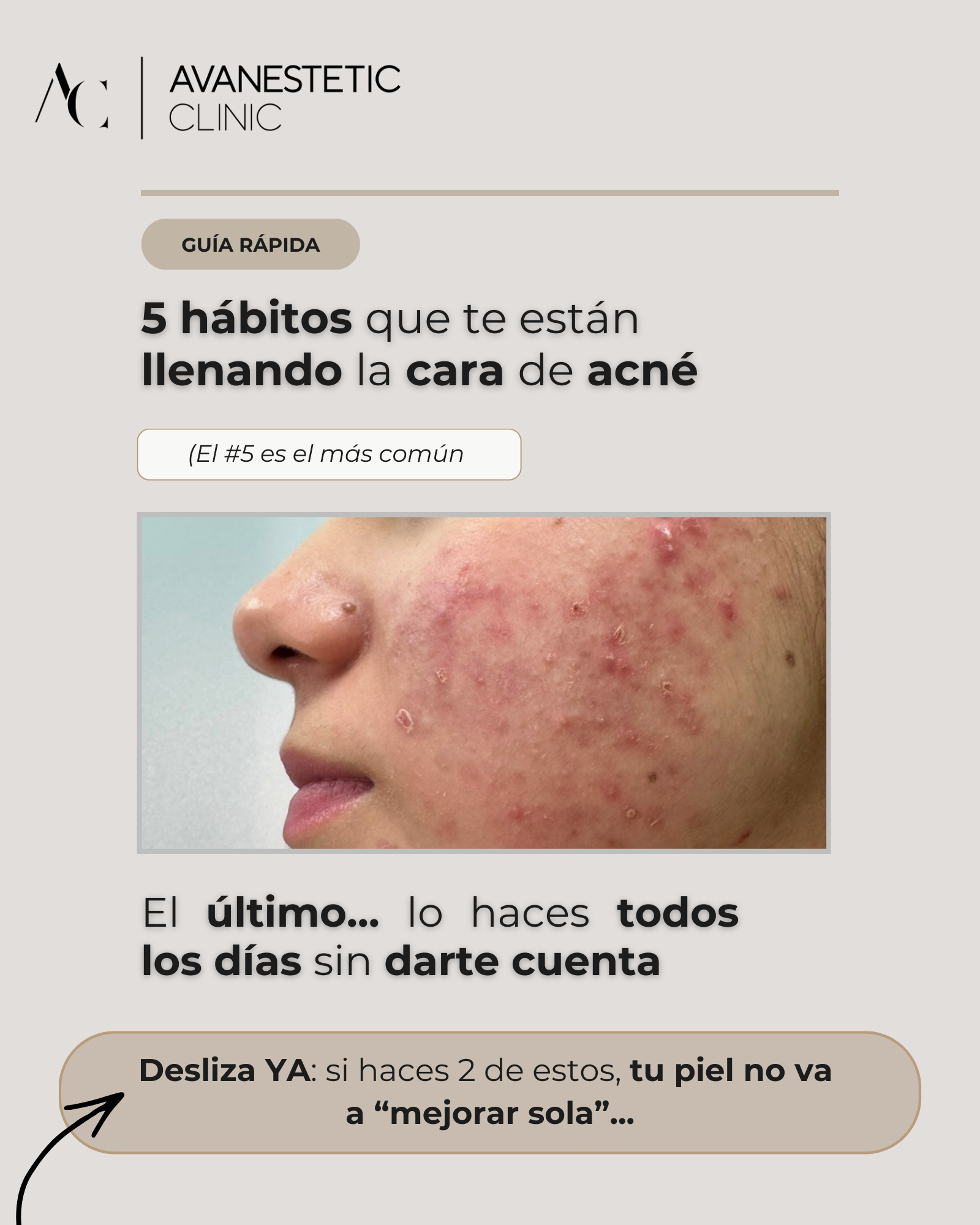 Avanestetic Clinic Barcelona Facebook ad: Si tienes acné… probablemente estás cometiendo al menos…