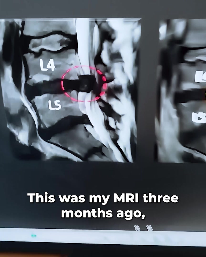 Life After Back Pain Facebook ad: Try This Before Falling Into Sciatica Surgery