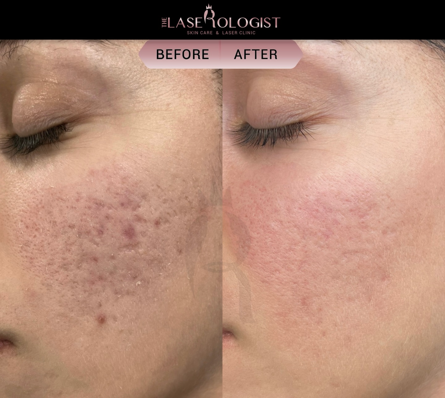 laserologist Facebook ad: A Fitzpatrick Skin Type III female presented with…