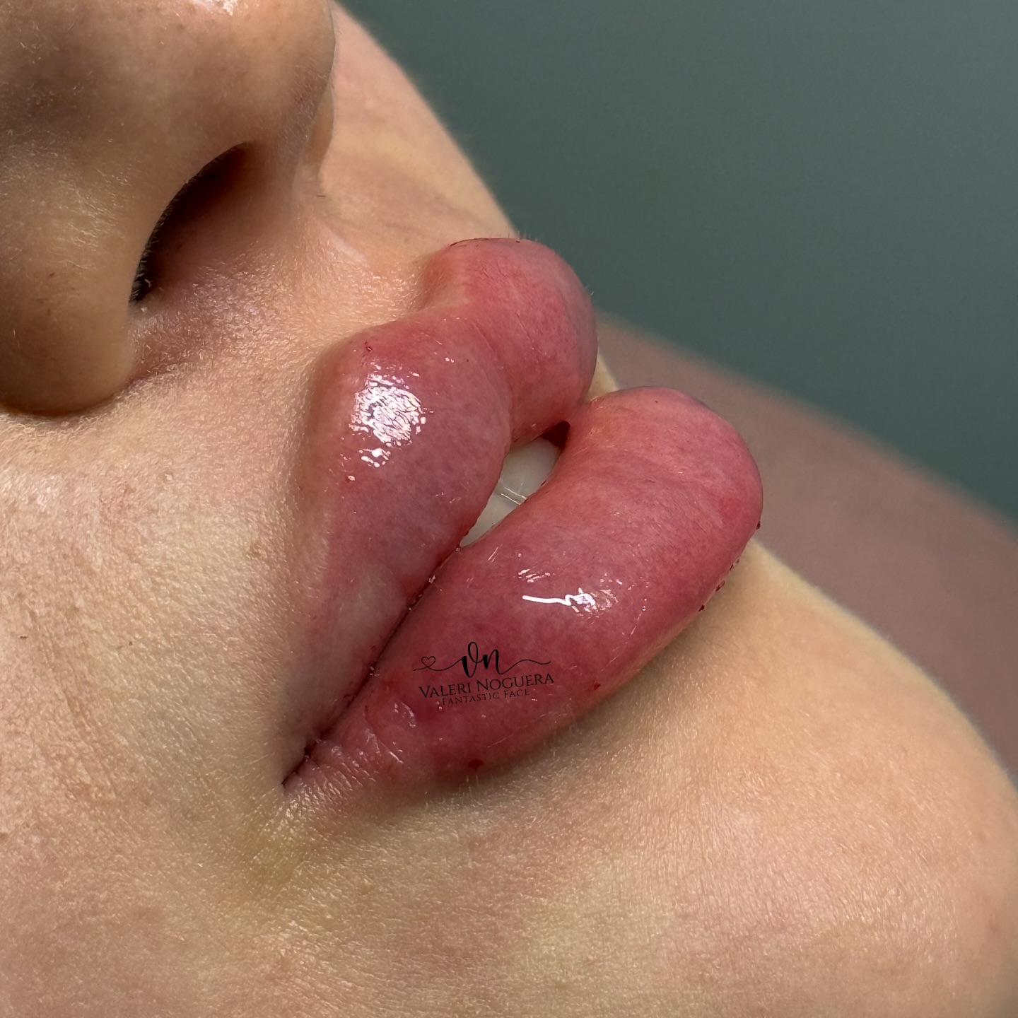 by_valeri_noguera Facebook ad: AUMENTO DE LABIOS EN ACIDO HIALURONICO