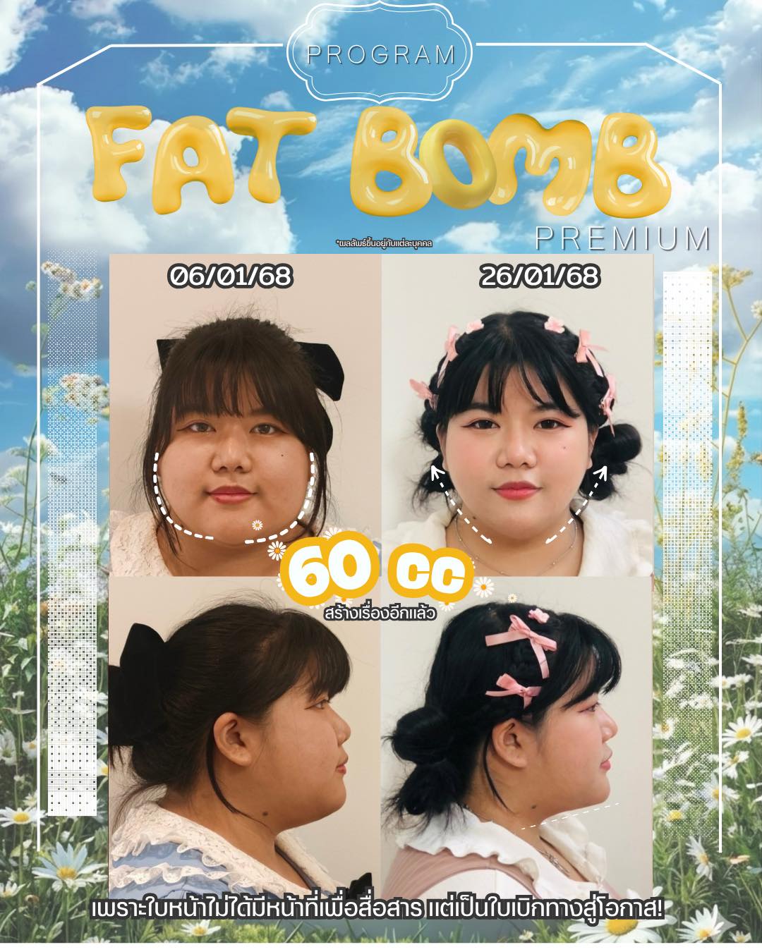 Oppa Skin Clinic - โอปป้าสกินคลินิก Facebook ad: โปรแกรม Fat Bomb Premium