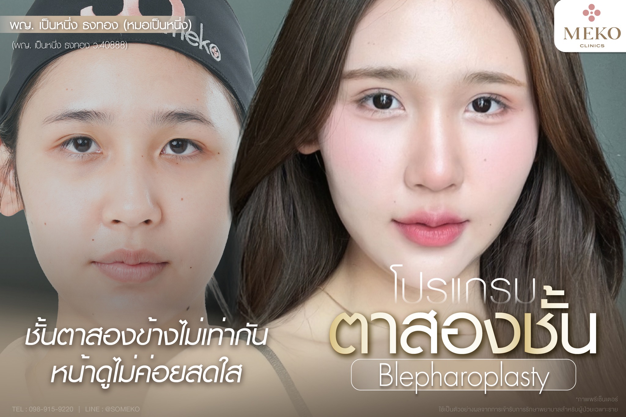 Meko Hospital โรงพยาบาล เมโกะ Facebook ad: เทคนิค Diamond Fix ปรับแต่งหนังตา ปรับแต่งไขมันเปลือกตา…